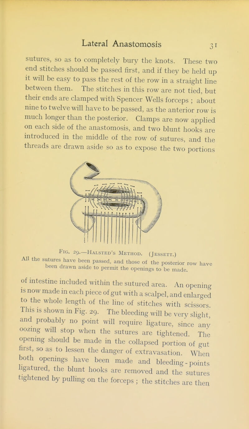 sutures, so as to completely bury the knots. These two end stitches should be passed first, and if they be held up it will be easy to pass the rest of the row in a straight line between them. The stitches in this row are not tied, but their ends are clamped with Spencer Wells forceps ; about nine to twelve will have to be passed, as the anterior row is much longer than the posterior. Clamps are now applied on each side of the anastomosis, and two blunt hooks are introduced in the middle of the row of sutures, and the threads are drawn aside so as to expose the two portions Fig. 29.—Halsted's Method. (Jessett.) AH the sutures have been passed, and those of the posterior row have Deen drawn aside to permit the openings to be made. of intestine included within the sutured area. An opening IS now made in each piece of gut with a scalpel, and enlarged to the whole length of the hne of stitches with scissors This IS shown in Fig. 29. The bleeding will be very slight and probably no point will require ligature, since any oozing will stop when the sutures are tightened The opening should be made in the collapsed portion of gut hrst, so as to lessen the danger of extravasation. When both openings have been made and bleeding - points ligatured, the blunt hooks are removed and the sutures tightened by pulling on the forceps ; the stitches are then