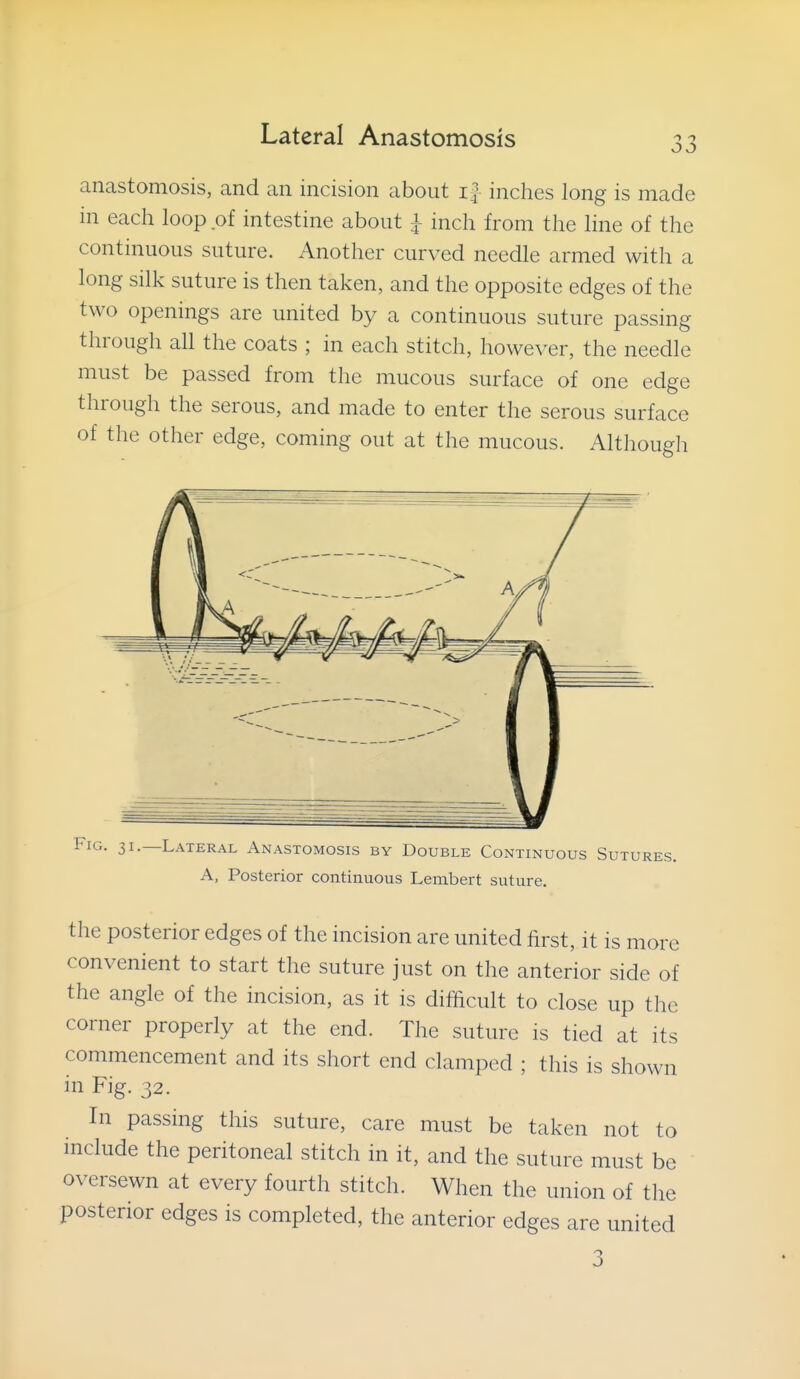 00 anastomosis, and an incision about i| inches long is made in each loop of intestine about i inch from the line of the continuous suture. Another curved needle armed with a long silk suture is then taken, and the opposite edges of the two openings are united by a continuous suture passing through all the coats ; in each stitch, however, the needle must be passed from the mucous surface of one edge through the serous, and made to enter the serous surface of the other edge, coming out at the mucous. Although Fig. 31.—Lateral Anastomosis by Double Continuous Sutures. A, Posterior continuous Lembert suture. the posterior edges of the incision are united first, it is more convenient to start the suture just on the anterior side of the angle of the incision, as it is difficult to close up the corner properly at the end. The suture is tied at its commencement and its short end clamped ; this is shown in Fig. 32. In passing this suture, care must be taken not to include the peritoneal stitch in it, and the suture must be oversewn at every fourth stitch. When the union of the posterior edges is completed, the anterior edges are united