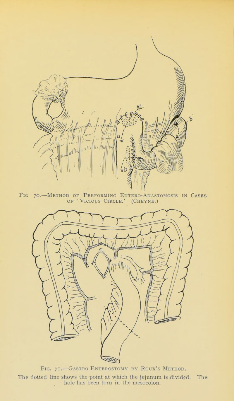 Fig 70,—Method of Performing Entero-Anastomosis in Cases OF ' Vicious Circle.' (Cheyne.) Fig. 71.—Gastro Enterostomy by Roux's Method. The dotted line shows the point at which the jejunum is divided. The hole has been torn in the mesocolon.