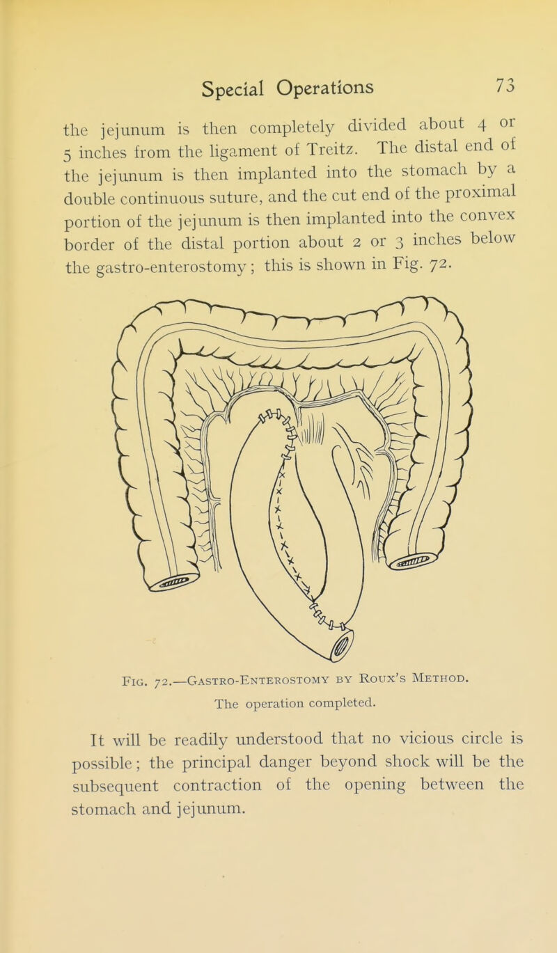 the jejunum is then completely divided about 4 or 5 inches from the hgament of Treitz. The distal end of the jejunum is then implanted into the stomach by a double continuous suture, and the cut end of the proximal portion of the jejunum is then implanted into the convex border of the distal portion about 2 or 3 inches below the gastro-enterostomy ; this is shown in Fig. 72. Fig. 72.—Gastro-Entekostomy by Roux's Method. The operation completed. It will be readily understood that no vicious circle is possible; the principal danger beyond shock will be the subsequent contraction of the opening between the stomach and jejunum.