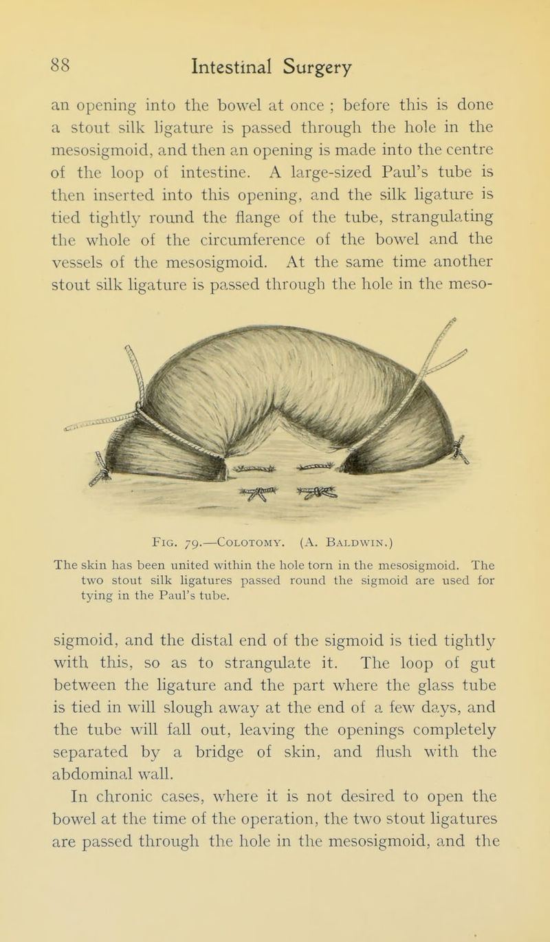 an opening into the bowel at once ; before this is done a stout silk h'gature is passed through the hole in the mesosigmoid, and then an opening is made into the centre of the loop of intestine. A large-sized Paul's tube is then inserted into this opening, and the silk ligature is tied tightly round the flange of the tube, strangulating the whole of the circumference of the bowel and the vessels of the mesosigmoid. At the same time another stout silk ligature is passed through the hole in the meso- The skin has been united within the hole torn in the mesosigmoid. The two stout silk ligatures passed round the sigmoid are used for tying in the Paul's tube. sigmoid, and the distal end of the sigmoid is tied tightly with this, so as to strangulate it. The loop of gut between the ligature and the part where the glass tube is tied in will slough away at the end of a few days, and the tube will fall out, leaving the openings completely separated by a bridge of skin, and flush with the abdominal wall. In chronic cases, where it is not desired to open the bowel at the time of the operation, the two stout ligatures are passed through the hole in the mesosigmoid, and the Fig. 79.—CoLOTOMY. (A. B.-vldwin.)