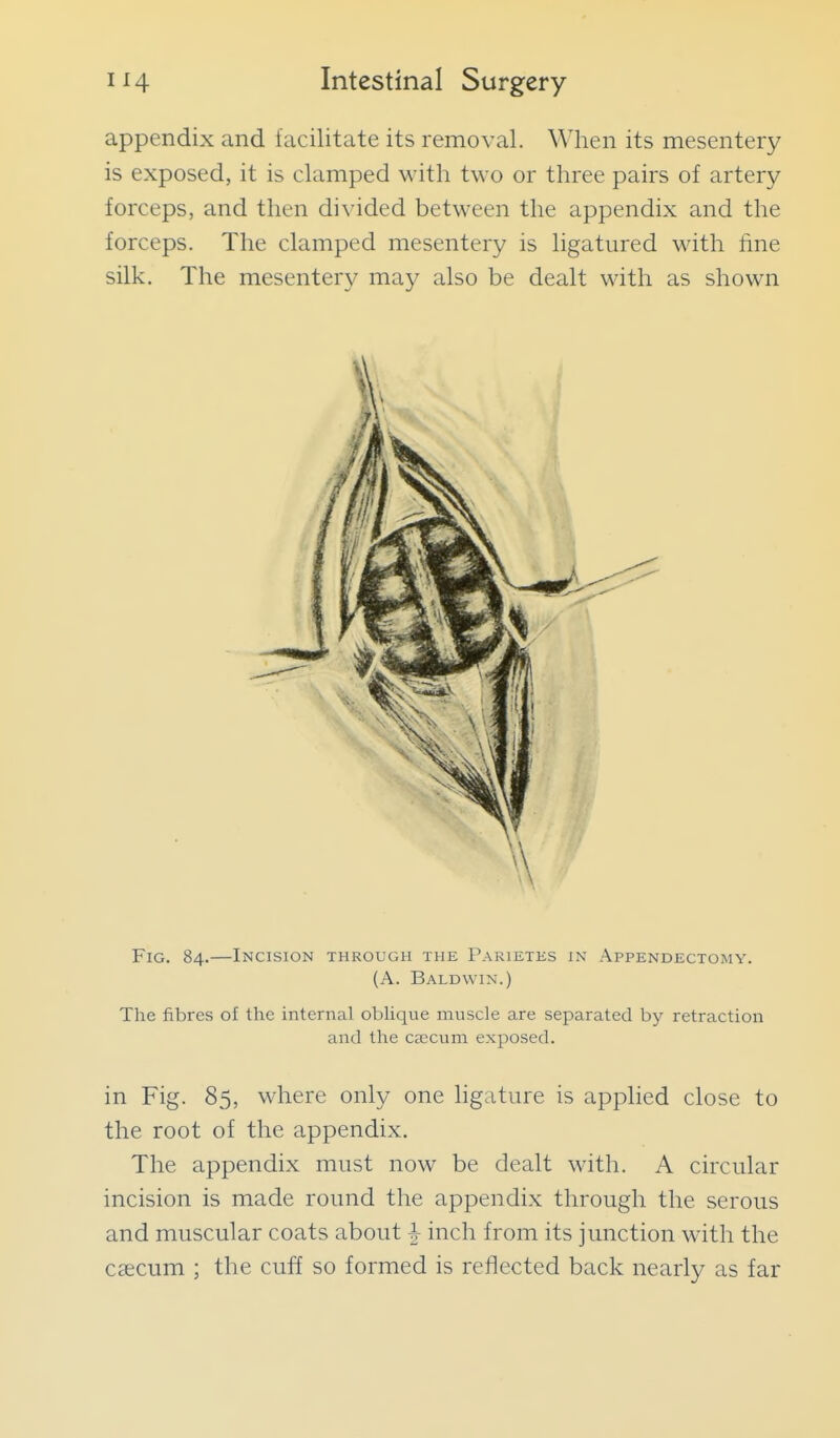 appendix and facilitate its removal. When its mesentery is exposed, it is clamped with two or three pairs of artery forceps, and then divided between the appendix and the forceps. The clamped mesentery is ligatured with fine silk. The mesentery may also be dealt with as shown Fig. 84.—Incision through the Parietes in Appendectomy. (A. Baldwin.) The fibres of the internal oblique muscle are separated by retraction and the caecum exposed. in Fig. 85, where only one hgature is applied close to the root of the appendix. The appendix must now be dealt with. A circular incision is made round the appendix through the serous and muscular coats about |- inch from its junction with the caecum ; the cuff so formed is reflected back nearly as far