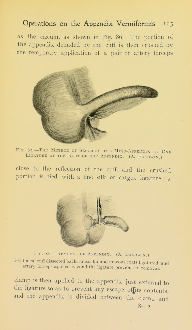 as the caecum, as shown in Fig. 86. The portion of the appendix denuded by the cuff is then crushed by the temporary apphcation of a pair of artery forceps Fig. 85.—The Method of Securing the Meso-Appendix by One Ligature at the Root of the Appendix. (A. Baldwin.) close to the reflection of the cuff, and the crushed portion is tied with a fine silk or catgut ligature ; a Fig. 86.—Removal of Appendix. (A. Baldwin.) Peritoneal cuff dissected back, muscular and mucous coats ligatured, and artery forceps applied beyond the ligature previous to removal.' clamp is then applied to the appendix just external to the hgature so as to prevent any escape of|its contents, and the appendix is divided between the clamp and 8-2