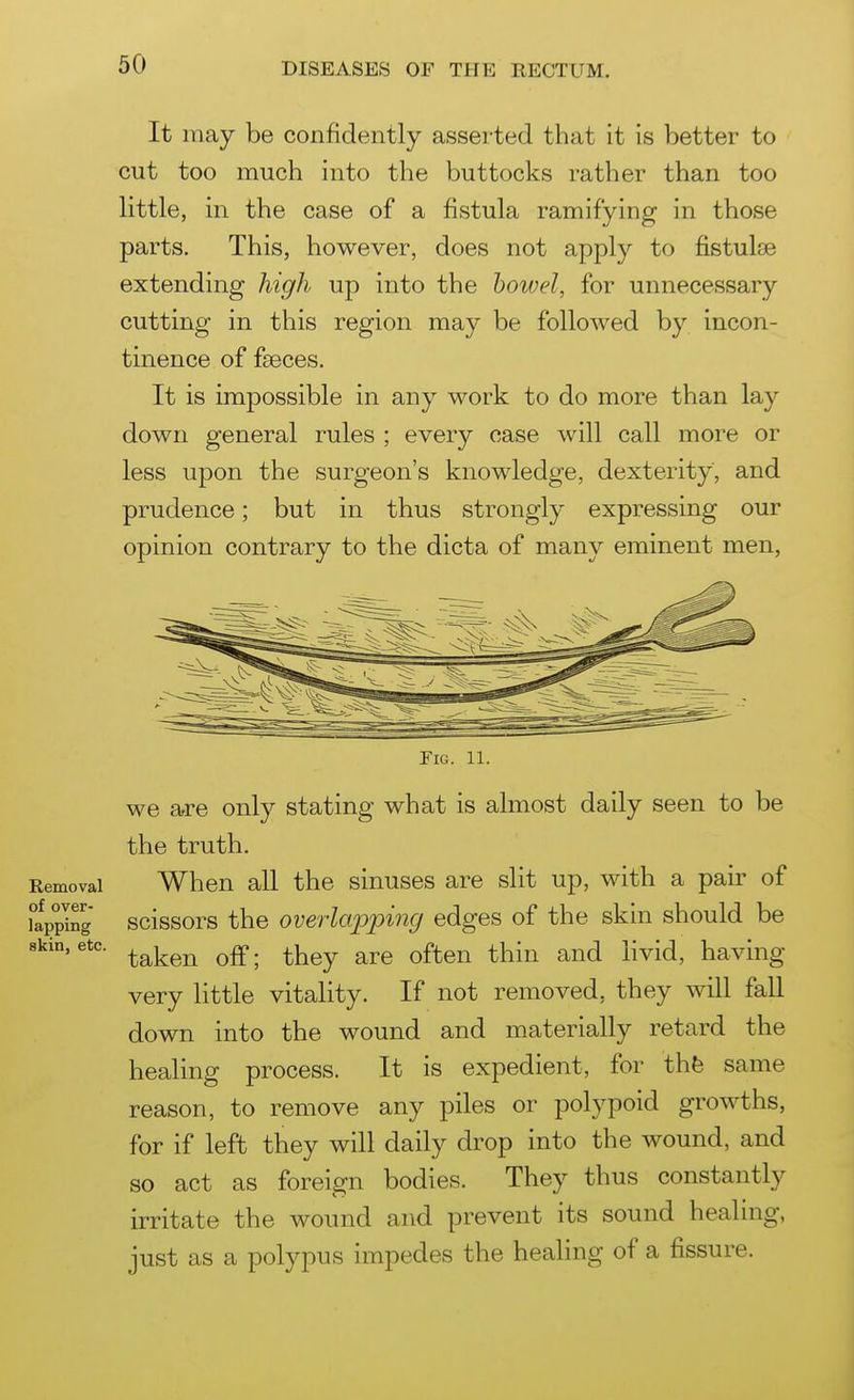 It may be confidently asserted that it is better to cut too much into the buttocks rather than too little, in the case of a fistula ramifying in those parts. This, however, does not apply to fistulse extending high up into the bowel, for unnecessary cutting in this region may be followed by incon- tinence of faeces. It is impossible in any work to do more than lay down general rules ; every case will call more or less upon the surgeon's knowledge, dexterity, and prudence; but in thus strongly expressing our opinion contrary to the dicta of many eminent men, Fig. 11. we are only stating what is almost daily seen to be the truth. Removal When all the sinuses are slit up, with a pair of itpplng scissors the overlapping edges of the skin should be skin, etc. ^^j^^^ ^g.. ^^gy ^^^^^ ^^^^ ^^^^ YiYid., having very little vitality. If not removed, they will fall down into the wound and m.aterially retard the healing process. It is expedient, for thfe same reason, to remove any piles or polypoid growths, for if left they will daily drop into the wound, and so act as foreign bodies. They thus constantly irritate the wound and prevent its sound healing, just as a polypus impedes the healing of a fissure. I