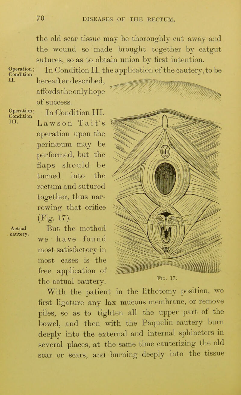 Operation Condition II. Operation; Condition III. Actual cautery. the old scar tissue may be thoroughly cut away and the wound so made brought together by catgut sutures, so as to obtain union by first intention. In Condition II. the application of the cautery, to be hereafter described, affordstheonlyhope of success. In Condition III. Lawson Tait's operation upon the perinseum may be performed, but the flaps should be turned into the rectum and sutured together, thus nar- rowing that orifice (Fig. 17). But the method we have found most satisfactory in most cases is the free application of the actual cautery. With the patient in the lithotomy position, we first ligature any lax mucous membrane, or remove piles, so as to tighten all the upper part of the bowel, and then with the Paquelin cautery burn deeply into the external and internal sphincters in several places, at the same time cauterizing the old scar or scars, and burning deeply into the tissue Fig. 17.