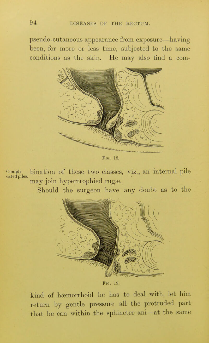 pseudo-cutaneous appearance from exposure—having been, for more or less time, subjected to the same conditions as the skin. He may also find a com- FiG. 18. CompH- bination of these two classes, viz., an internal pile cated piles. may join hypertrophied rugse. Should the surgeon have any doubt as to the Fig. 19. kind of hsemorrhoid he has to deal with, let him return by gentle pressure all the protruded part that he can within the sphincter ani—at the same