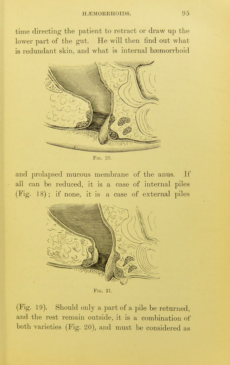 time directing the patient to retract or draw up the lower part of the gut. He will then find out what is redundant skin, and what is internal hsemorrhoid Fig. 20. and j)rolapsed mucous membrane of the anus. If all can be reduced, it is a case of internal piles (Fig. 18); if none, it is a case of external piles Fig. 21. (Fig. 19). Should only a part of a pile be returned, and the rest remain outside, it is a combination of both varieties (Fig. 20), and must be considered as