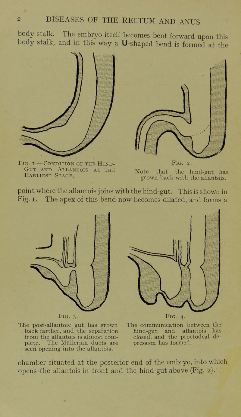 body stalk. The embryo itself becomes bent forward upon this body stalk, and in this way a U-shaped bend is formed at the Fig. I.—Condition of the Hind- Gut AND AlLANTOIS AT THE Earliest Stage. Note that the hind-gut has grown back with the allantois. point where the allantois joins with the hind-gut. This is shown in Fig. I. The apex of this bend now becomes dilated, and forms a Fig. 3. The post-allantoic gut has grown back farther, and the separation from the allantois is almost com- plete. The Miillerian ducts are ! seen opening into the allantois. Fig. 4. The communication between the hind-gut and allantois has closed, and the proctodeal de- pression has formed. chamber situated at the posterior end of the embryo, into which opens the allantois in front and the hind-gut above (Fig. 2).