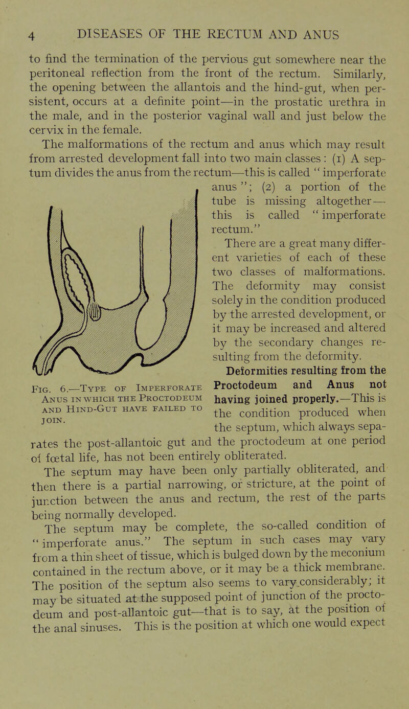 to find the termination of the pervious gut somewhere near the peritoneal reflection from the front of the rectum. Similarly, the opening between the allantois and the hind-gut, when per- sistent, occurs at a definite point—in the prostatic urethra in the male, and in the posterior vaginal wall and just below the cervix in the female. The malformations of the rectum and anus which may result from arrested development fall into two main classes : (i) A sep- tum divides the anus from the rectum—this is called  imperforate anus; (2) a portion of the tube is missing altogether— this is called  imperforate rectum. There are a great many differ- ent varieties of each of these two classes of malformations. The deformity may consist solely in the condition produced by the arrested development, or it may be increased and altered by the secondary changes re- sulting from the deformity. Deformities resulting from the Pig. 6.—Type of Imperforate Proctodeum and Anus not Anus in which the Proctodeum having joined properly.—This is AND HiND-GuT HAVE FAILED TO cOndition prodUCCd whcu JOIN. , - f - . the septum, which alwajrs sepa- rates the post-allantoic gut and the proctodeum at one period of fcetal hfe, has not been entirely obliterated. The septum may have been only partially obliterated, and then there is a partial narrowing, of stricture, at the point of junction between the anus and rectum, the rest of the parts being normally developed. The septum may be complete, the so-called condition of imperforate anus. The septum in such cases may vai-y from a thin sheet of tissue, which is bulged down by the meconium contained in the rectum above, or it may be a thick membrane. The position of the septum also seems to vary considerably; it may be situated at the supposed point of junction of the procto- deum and post-allantoic gut—that is to say, at the position of the anal sinuses. This is the position at which one would expect