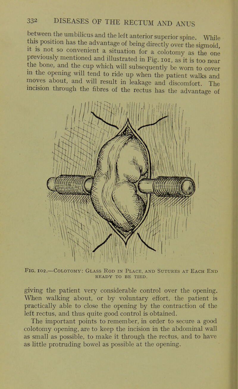 between the umbilicus and the left anterior superior spine. While this position has the advantage of being directly over the sigmoid It is not so convenient a situation for a colotomy as the one previously mentioned and illustrated in Fig. loi, as it is too near the bone, and the cup which will subsequently be worn to cover m the opening will tend to ride up when the patient walks and moves about, and will result in leakage and discomfort The incision through the fibres of the rectus has the advantage of Fig. I02.—Colotomy: Glass Rod in Place, and Sutures at Each End READY to be TIED. giving the patient very considerable control over the opening. When walking about, or by voluntary effort, the patient is practically able to close the opening by the contraction of the left rectus, and thus quite good control is obtained. The important points to remember, in order to secure a good colotomy opening, are to keep the incision in the abdominal wall as small as possible, to make it through the rectus, and to have as little protruding bowel as possible at the opening.