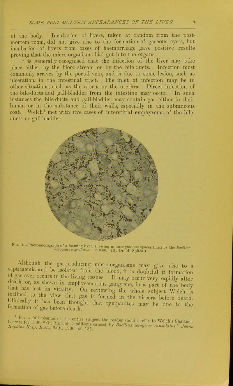 of the body. Incubation of livers, taken at random fi'om the post- mortem room, did not give rise to the formation of gaseous cysts, but incubation of livers from cases of haemorrhage gave positive results proving that the micro-organisms had got into the organs. It is generally recognised that the infection of the liver may take place either by the blood-stream or by the bile-ducts. Infection most commonly arrives by the portal vein, and is due to some lesion, such as ulceration, in the intestinal tract. The inlet of infection may be in other situations, such as the uterus or the urethra. Direct infection of the bile-ducts and gall-bladder from the intestine may occur. In such instances the bile-ducts and gall-bladder may contain gas either in their lumen or in the substance of their walls, especially in the submucous coat. Welch^ met with five cases of interstitial emphysema of the bile- ducts or gall-bladder. Although the gas-producing micro-organisms may give rise to a septicaemia and be isolated from the blood, it is doubtful if formation ot gas ever occurs in the living tissues. It may occur very rapidly after cicath or, as shewn in emphysematous gangrene, in a part of the body that has lost Its vitality. On reviewing the whole subject AVelch is inclined to the view that gas is formed in the viscera before death. \.ZT^^ f^^^ tympanites may be due to the toi-mation of gas before death. l^'^l^^-^Tiovltfi'^'-^^^^^ the reader should refer to Welch's Shattuck Hopkins Bait. 1900? xt^^ ^'•^^^^ oapsulatnsr Johns