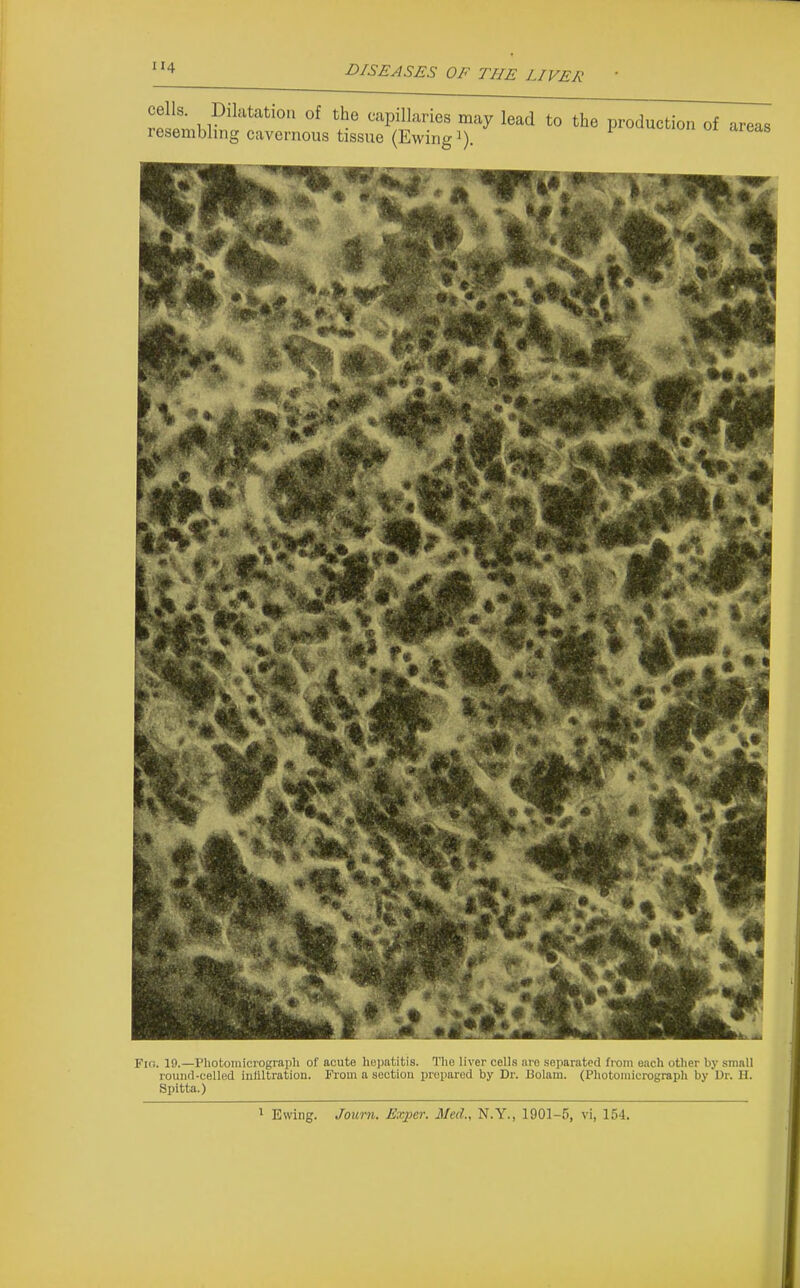 H4 cells. Dilatation of the capillaries may lead to the production of resembling cavernous tissue (Ewingi). areas Fio. 19.—Photomicrograph of acute hepatitis. The liver cells are separated from each other by small roiinfl-celled infiltration. From a section prepared by Dr. Bolam. (Photomicrograph by Dr. H. Spitta.) ^ Ewing. Journ. Exper. Med., N.Y., 1901-5, vi, 154.