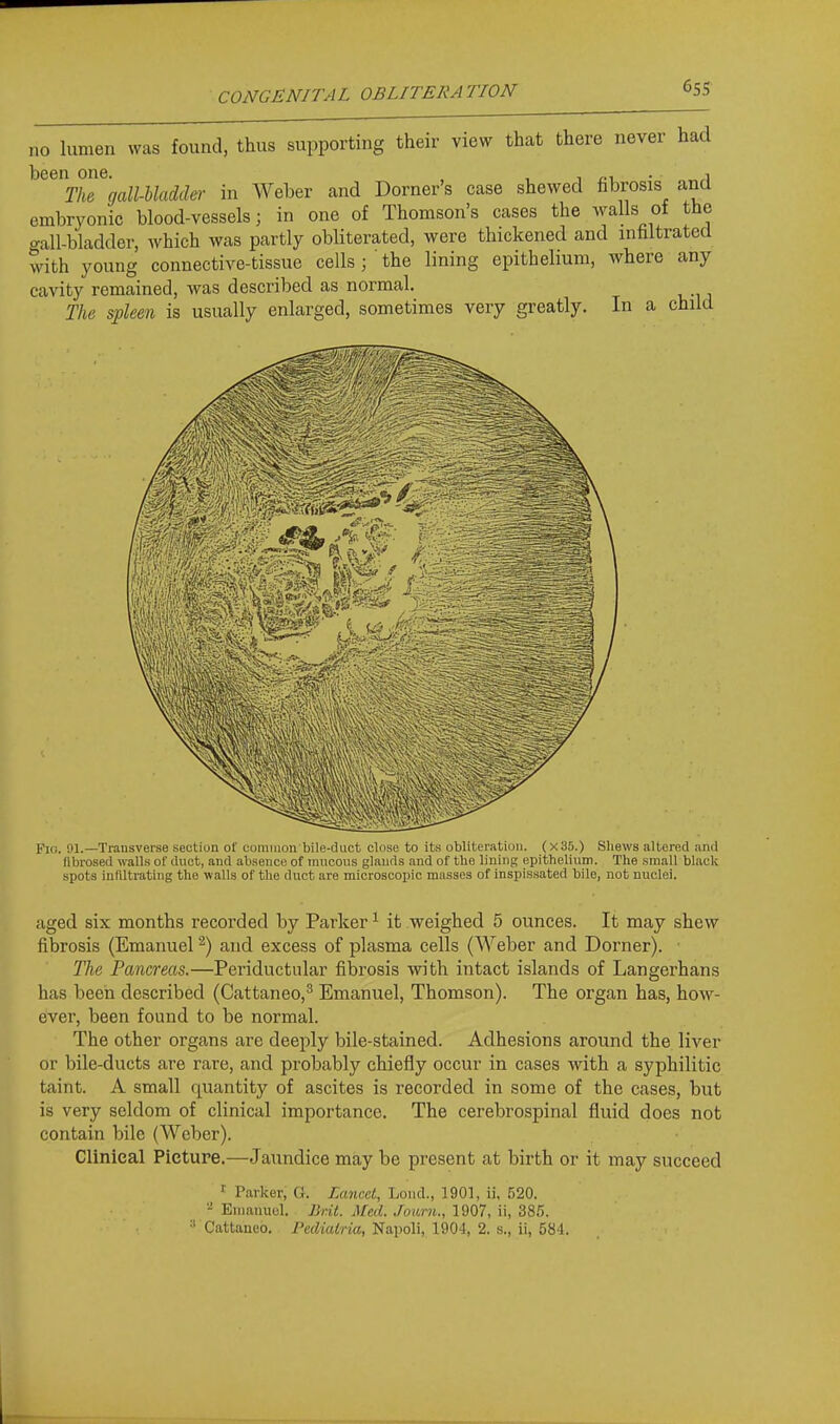 no lumen was found, thus supporting their view that there never had ^^^\Z%aimacUe,' in Weber and Dorner's case shewed fibrosis and embryonic blood-vessels; in one of Thomson's cases the walls of the gall-bladder, which was partly obliterated, were thickened and infiltrated with young connective-tissue cells; the lining epithelium, where any cavity remained, was described as normal. The spleen is usually enlarged, sometimes very greatly. In a child Fifi. 91.—Transverse section of cumiiion bile-duct close to its obliteration. (x35.) Shews altered and fibrosed walls of dnct, and absence of inncons glands and of the lining epithelinm. The small black spots infiltrating the walls of the duct are microscopic masses of inspissated bile, not nuclei. aged six months recorded by Parker ^ it weighed 5 ounces. It may shew fibrosis (Emanuel and excess of plasma cells (Weber and Dorner). The Pancreas.—Periductiilar fibrosis vnth intact islands of Langerhans has been described (Cattaneo,^ Emanuel, Thomson). The organ has, how- eiver, been found to be normal. The other organs are deeply bile-stained. Adhesions around the liver or bile-ducts are rare, and probably chiefly occur in cases with a syphilitic taint. A small quantity of ascites is recorded in some of the cases, but is very seldom of clinical importance. The cerebrospinal fluid does not contain bile (Weber). Clinical Picture.—Jaundice may be present at birth or it may succeed Parker, G. Tkmcet, Loud., 1901, ii, 520. - Enianuol. Brit. Med. Journ., 1907, ii, 38.'). •' Cattaueo. Pediairia, Napoli, 1904, 2. s., ii, 584.