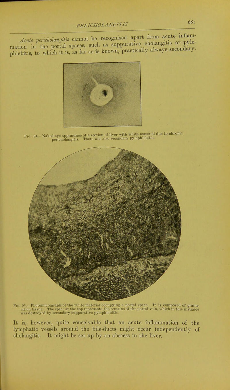 PERICHOLANGn IS Acute pericholangitis cannot be recognised apart ^^^^^.^^^^^ mation in the portal spaces, such as suppurative cholangitis or pyle pl lebTtis to whic^^ it is, as far as is known, practically always secondary. Fig. 94.-Naked-eye appearance of a section of liver with wl.ite material due to clironic pericholangitis. There was also secondary pylephlebitis. i Fid. 9.1.—Photomicrograph of the wliiti: material occupying a portiil .space. It is composed of granu- lation tissue. Tlie space at tlic. top represents tlie remains of the portal vein, which in tliis instance was destroyed by secondary suppurative pylephlebitis. It is, however, quite conceivable that an acute inflammation of the lymphatic vessels around the bile-ducts might occur independently of cholangitis. It might be set up by an abscess in the liver.