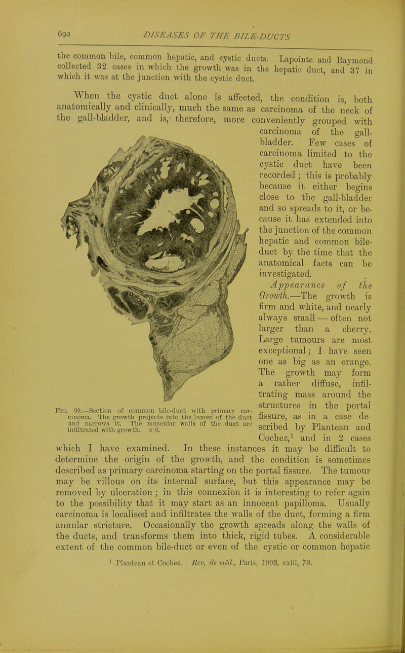 the common bile, common liepatic, and cystic ducts. Lapointe and Raymond collected 32 cases in which the growth was in the hepatic duct, and 37 in which it was at the junction with the cystic duct. When the cystic duct alone is affected, the condition is, both anatomically and clinically, much the same as carcinoma of the neck of the gall-bladder, and is,' therefore, more conveniently grouped with carcinoma of the gall- bladder. Few cases of carcinoma limited to the cystic duct have been recorded ; this is probably because it either begins close to the gall-bladder and so spreads to it, or be- cause it has extended into the junction of the common hepatic and common bile- duct by the time that the anatomical facts can be investigated. Appearance of the Growth.—The growth is firm and white, and nearly always small — often not larger than a cherry. Large tumours are most exceptional; I have seen one as big as an orange. The growth may form a rather diffuse, infil- trating mass around the structures in the portal Fio. 99.—Section of common bile-duct with primary car- „ . , cinoma. Tlie growtli projects into the lumen of the duct nSSUrC, aS in a CaSC dC- and narrows it. The muscular walls of the duct are „„„,'U„J i,„ r)1„„4-„„„ 3 intiitrated with growth, x 6. scribcd by Flanteau and Cochez,^ and in 2 cases which I have examined. In these instances it may be difficult to determine the origin of the growth, and the condition is sometimes described as primary carcinoma starting on the portal fissure. The tumour may be villous on its internal surface, but this appearance may be removed by ulceration ; in this connexion it is interesting to refer again to the possibility that it may start as an innocent papilloma. Usually carcinoma is localised and infiltrates the walls of the duct, forming a firm annular stricture. Occasionally the growth spreads along the walls of the ducts, and transforms them into thick, rigid tubes. A considerable extent of the common bile-duct or even of the cystic or common hepatic ^ Planteau et Cocliez. Rev. de med., Pari.s, 1903, .\xiii, 70.