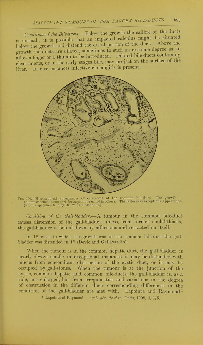 Condition of the Bile-ducts.-Be\ow the growth the calibre of the ducts is normal; it is possible that an impacted calculus might be situated helow the growth and distend the distal portion of the duct Above the growth the ducts are dilated, sometimes to such an extreme degree as to allow a finger or a thumb to be introduced. Dilated bile-ducts containing clear mucus, or in the early stages bile, may project on the surface of the liver. In rare instances infective cholangitis is present. Fir,. 100.—Jlicroscopical appearances of caiciuoma of the common bile-d\ict. The growth is columnar-celled in one part, but squamous-celled in others. The latter is an exceptional appearance. (From a specimen lent by Dr. W. C. Bosanquet.) Condition of the Gall-bladder.—A tumour in the common bile-duct causes distension of the gall-bladder, unless, from former cholelithiasis, the gall-bladder is bound down by adhesions and retracted on itself. In 18 cases in which the growth was in the common bile-duct the gall- bladder was distended in 17 (Devic and Gallavardin). When the tumour is in the common hepatic duct, the gall-bladder is nearly always small; in exceptional instances it may be distended with mucus from concomitant obstruction of the cystic duct, or it may be occupied by gall-stones. When the tumour is at the junction of the cystic, common hepatic, and common bile-ducts, the gall-bladder is, as a rule, not enlarged, but from irregularities and variations in the degree of obstruction in the different ducts corresponding differences in the condition of the gall-bladder are met with. Lapointe and Raymond^