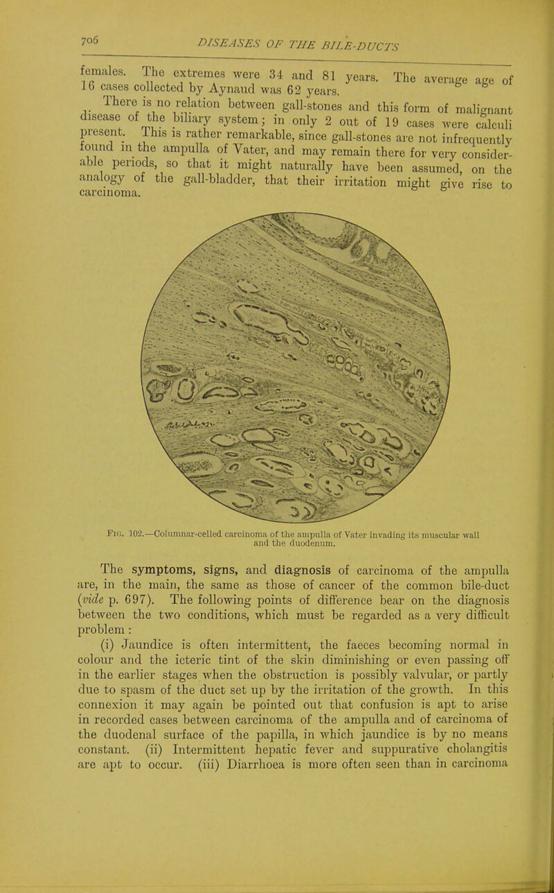 females. The extremes were 34 and 81 years. The average age of 16 cases collected by Aynaud was 62 years. There is no relation between gall-stones and this form of malignant disease of the biliaiy system; in only 2 out of 19 cases were cSlculi present. This is rather remarkable, since gall-stones are not infrequently found m the ampulla of Vater, and may remain there for very consider- able periods, so that it might naturally have been assumed, on the analogy of the gall-bladder, that their irritation might give rise to carcinoma. Fio. 102.—Columnar-celled carcinoma of the ampulla of Vater invading its muscular wall and the duodenum. The symptoms, signs, and diagnosis of carcinoma of the ampulla are, in the main, the same as those of cancer of the common bile-duct (mZe p. 697). The following points of difference bear on the diagnosis between the two conditions, which must be regarded as a very difficult problem: (i) Jaundice is often intermittent, the faeces becoming normal in colour and the icteric tint of the skin diminishing or even passing oil' in the earlier stages when the obstruction is possibly valvular, or partly due to spasm of the duct set up by the irritation of the growth. In this connexion it may again be pointed out that confusion is apt to arise in recorded cases between carcinoma of the ampulla and of carcinoma of the duodenal surface of the papilla, in which jaundice is by no means constant, (ii) Intermittent hepatic fever and suppurative cholangitis are apt to occur, (iii) Diarrhoea is more often seen than in carcinoma
