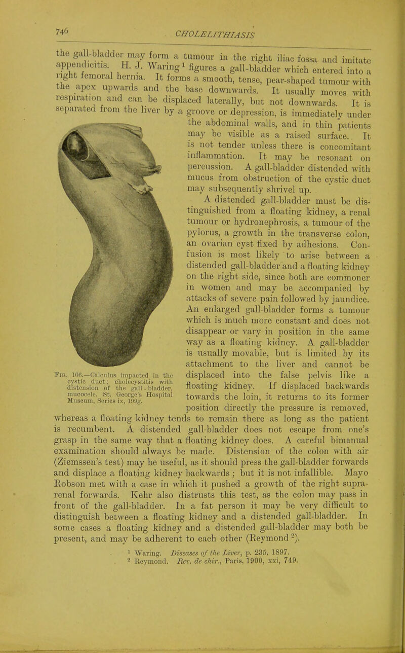 S 1 . ^^r'T^ ^ gall-bladder which entered into a ight femoral hernia. It forms a smooth, tense, pear-shaped tumour with the apex upwards and the base downwards. It usually moves with respiration and can be displaced laterally, but not downwards. It is separated from the liver by a groove or .depression, is immediately under the abdominal walls, and in thin patients may be visible as a raised surface. It is not tender unless there is concomitant inflammation. It may be resonant on percussion. A gall-bladder distended with mucus from obstruction of the cystic duct may subsequently shrivel up. A distended gall-bladder must be dis- tinguished from a floating kidney, a renal tumour or hydronephrosis, a tumour of the pylorus, a growth in the transverse colon, an ovarian cyst fixed by adhesions. Con- fusion is most likely to arise between a distended gall-bladder and a floating kidney on the right side, since both are commoner in women and may be accompanied bj'- attacks of severe pain followed by jaundice. An enlarged gall-bladder forms a tumour which is much more constant and does not disappear or vary in position in tlie same way as a floating kidney. A gall-bladder is usually movable, but is limited by its attachment to the liver and cannot be displaced into the false pelvis like a floating kidney. If displaced backwards towards the loin, it returns to its former position directly the pressure is removed, whereas a floating kidney tends to remain there as long as the patient is recumbent. A distended gall-bladder does not escape from one's grasp in the same way that a floating kidney does. A careful bimanual examination should always be made. Distension of the colon with air (Ziemssen's test) may be useful, as it should press the gall-bladder forwards and displace a floating kidney backwards ; but it is not infallible. Mayo Eobson met with a case in which it pushed a growth of the right supra- renal forwards. Kehr also distrusts this test, as the colon may pass in front of the gall-bladder. In a fat person it may be very difficult to distinguish between a floating kidney and a distended gall-bladder. In some cases a floating kidney and a distended gall-bladder may both be present, and may be adherent to each other (Reymond > Waring. Diseases of the Liver,-p. 235, 1897. 2 Reymond. Rev. dc chir., Paris, 1900, x.\i, 749. Fio. 106.—CalcMlus impuettid in i\u: cystic duct; cliolecystitis with di.stension of the gall - bladder, mucocele. St. George's Hospital Museum, Series ix, 199g.