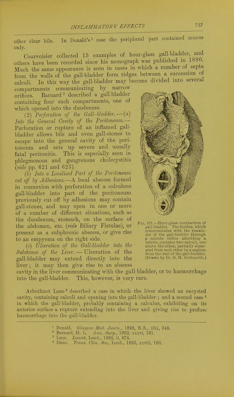 other clear bile. In Donald's i case the peripheral part contained mucus only. Courvoisier collected 15 examples of hour-glass gall-bladder and others have been recorded since his monograph was pubhshed in 189U. Much the same appearance is seen in cases in which a number of septa from the walls of the gall-bladder form ridges between a succession ot calculi. In this way the gall-bladder may become divided into several compartments communicating by narrow orifices. Barnard ^ described a gall-bladder containing four such compartments, one of which opened into the duodenum. (2) Perfffi-ation of the Gall-bladder. — {a) Into the General Cavity of the Peritoneum.— Perforation or rupture of an inflamed gall- bladder allows bile and even gall-stones to escape into the general cavity of the peri- toneum and sets up severe and usually fatal peritonitis. This is especially seen in phlegmonous and gangrenous cholecystitis \vide pp. 621 and 623). (&) Into a Localised Part of the Peritoneum cut off by Adhesions.—A local abscess formed in connexion with perforation of a calculous gall-bladder into part of the peritoneum previously cut off by adhesions may contain gall-stones, and may open in one or more of a number of different situations, such as the duodenum, stomach, on the surface of the abdomen, etc. (vide Biliary Fistulae), or present as a subphrenic abscess, or give rise to an empyema on the right side. (c) Ulceration of the Gall-bladder into the Substance of the Liver. — Ulceration of the gall-bladder may extend directly into the liver; it may then give rise to an abscess cavity in the liver communicating with the gall-bladder, or to haemorrhage into the gall-bladder. This, however, is very rare. Arbuthnot Lane^ described a case in which the liver shewed an encysted cavity, containing calculi and opening into the gall-bladder ; and a second case * in which the gall-bladder, probably containing a calculus, exhibiting on its anterior surface a rupture extending into the liver and giving rise to profuse haemorrhage into the gall-bladder. Fio. 107.—Hour-glass contraction of gall-bladder. The fundus, wliich communicates with the remain- der of the gall-bladder through a minute orifice admitting a bristle, contains two calculi, one above the other, partially separ- ated from each other by a septum from the wall of the gall-bladder. (Drawn by Dr. G. H. Goldsmith.) 1 Donald. Glmgovi Med. Journ., 1898, N.S., xlix, 348. - Barnard, 11. L. Ann. Surg., 1902, xxxvi, 161. Lane. Lancet, Lend., 1893, ii, 874. ■* idem. Trans. Clin. Soc, Lend., 1896, xxviii, 160.