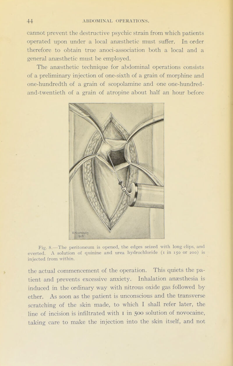 cannot prevent the destructive psychic strain from which patients operated upon under a local anaesthetic must suffer. In order therefore to obtain true anoci-association both a local and a general anaesthetic must be employed. The anaesthetic techniciue for abdominal operations consists of a preliminary injection of one-sixth of a grain of morphine and one-hundredth of a grain of scopolamine and one one-hundred- and-twentieth of a grain of atropine about half an hour before 8,—The peritoneum is opened, the edges seized with long chps, and everted. A solution of quinine and urea hj-drochloride (i in 150 or 200) is injected from within. the actual commencement of the operation. This quiets the pa- tient and prevents excessive anxiety. Inhalation anaesthesia is induced in the ordinary way with nitrous oxide gas followed by ether. As soon as the patient is unconscious and the transverse scratching of the skin made, to which I shall refer later, the line of incision is infiltrated with i in 500 solution of novocaine, taking care to make the injection into the skin itself, and not