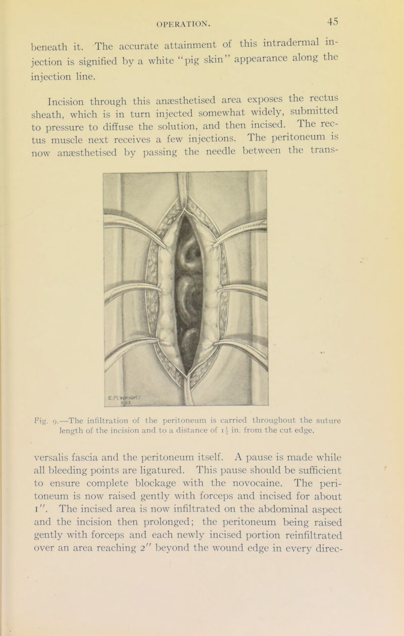 beneath it. The accurate attainment of this intradermal in- jection is signified by a white pig skin appearance along the injection line. Incision through this anaesthetised area exposes the rectus sheath, which is in turn injected somewhat widely, submitted to pressure to diffuse the solution, and then incised. The rec- tus muscle next receives a few injections. The peritoneum is now an^sthetised by passing the needle between the trans- Fi;^. <).—-The infiltration of the peritoneum is carried throughout the suture length of the incision and to a distance of in. from the cut edge. versalis fascia and the peritoneum itself. A pause is made while all bleeding points are ligatured. This pause should be sufficient to ensure complete blockage with the novocaine. The peri- toneum is now raised gently with forceps and incised for about i. The incised area is now infiltrated on the abdominal aspect and the incision then prolonged; the peritoneum being raised gently with forceps and each newly incised portion reinfiltrated over an area reaching 2 beyond the wound edge in every direc-