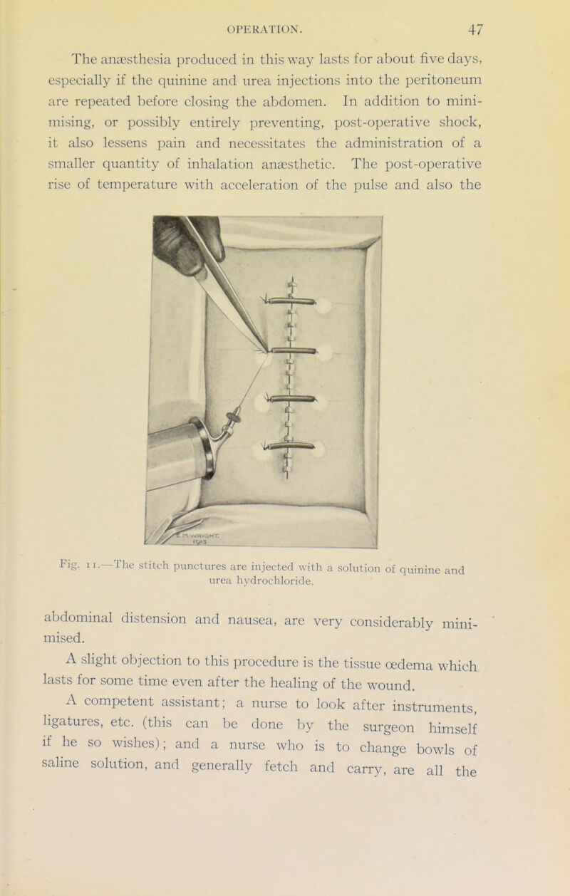 The anaesthesia produced in this way lasts for about five days, especially if the quinine and urea injections into the peritoneum are repeated before closing the abdomen. In addition to mini- mising, or possibly entirely preventing, post-operative shock, it also lessens pain and necessitates the administration of a smaller quantity of inhalation anaesthetic. The post-operative rise of temperature with acceleration of the pulse and also the Fig. II.—TIk- slitch punctures are injected with a solution of quinine and urea hvdrocliloride. abdominal distension and nausea, are very considerably mini- mised. A slight objection to this procedure is the tissue oedema which lasts for some time even after the heahng of the wound. A competent assistant; a nurse to look after instruments, ligatures, etc. (this can be done by the surgeon himself if he so wishes); and a nurse who is to change bowls of saline solution, and generally fetch and carry, are all the