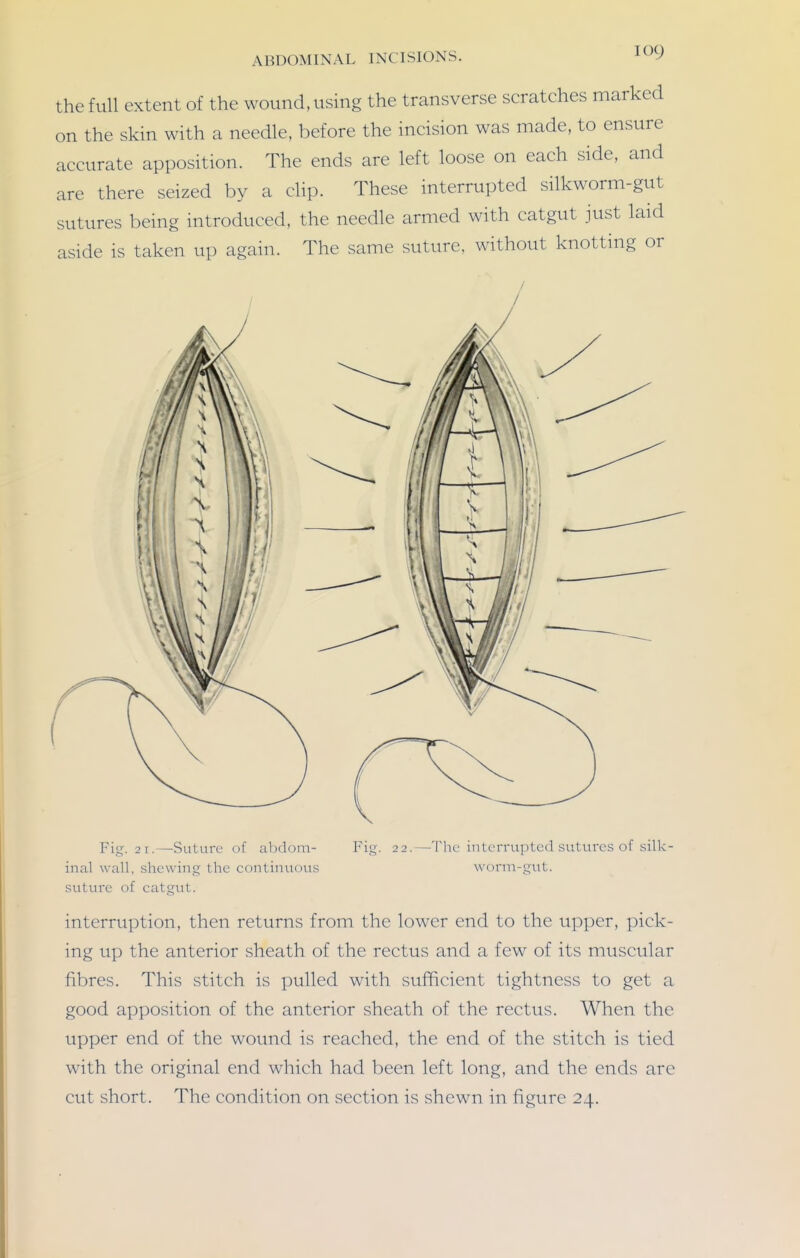 the full extent of the wound, using the transverse scratches marked on the skin with a needle, before the incision was made, to ensure accurate apposition. The ends are left loose on each side, and are there seized by a clip. These interrupted silkworm-gut sutures being introduced, the needle armed with catgut just laid aside is taken up again. The same suture, without knotting or Fig. 2 1.—Suture of abdom- inal wall, shewing the continuous suture of catgut. Fig. 22.—The interrujitcd sutures of silk- worm-Q'ut. interruption, then returns from the lower end to the upper, pick- ing up the anterior sheath of the rectus and a few of its muscular fibres. This stitch is pulled with sufficient tightness to get a good apposition of the anterior sheath of the rectus. When the upper end of the wound is reached, the end of the stitch is tied with the original end which had been left long, and the ends are cut short. The condition on section is shewn in figure 24.