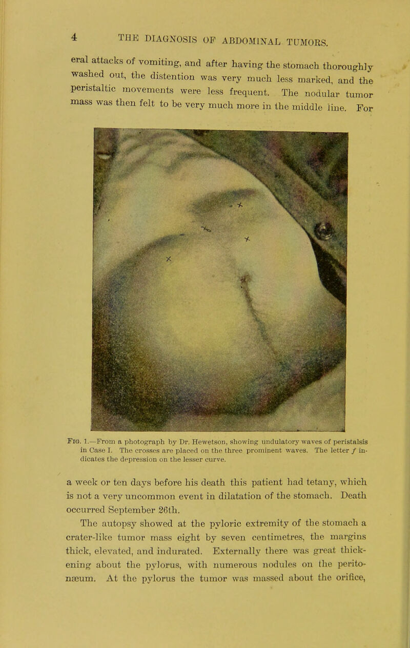 eral attacks of vomiting, and after having the stomach thoroughly washed out, the distention was very much less marked, and the peristaltic inovements were less frequent. The nodular tumor mass was then felt to be very much more in the middle line. For Fig. 1.—From a photograph by Dr. Hewetson, showing undulatory^va ^ : iieristalsis in Case I. The crosses are placed on the three prominent waves. The letter / in- dicates the depression on the lesser curve. a week or ten days before his death this patient had tetany, which is not a very uncommon event in dilatation of the stomach. Death occurred September 26th. The autopsy showed at the pyloric extremity of the stomach a crater-like tumor mass eight by seven centimetres, the margins thick, elevated, and indurated. Externally there was great thick- ening about the pylorus, with numerous nodules on the perito- naeum. At the pylorus the tumor was massed about the orifice,