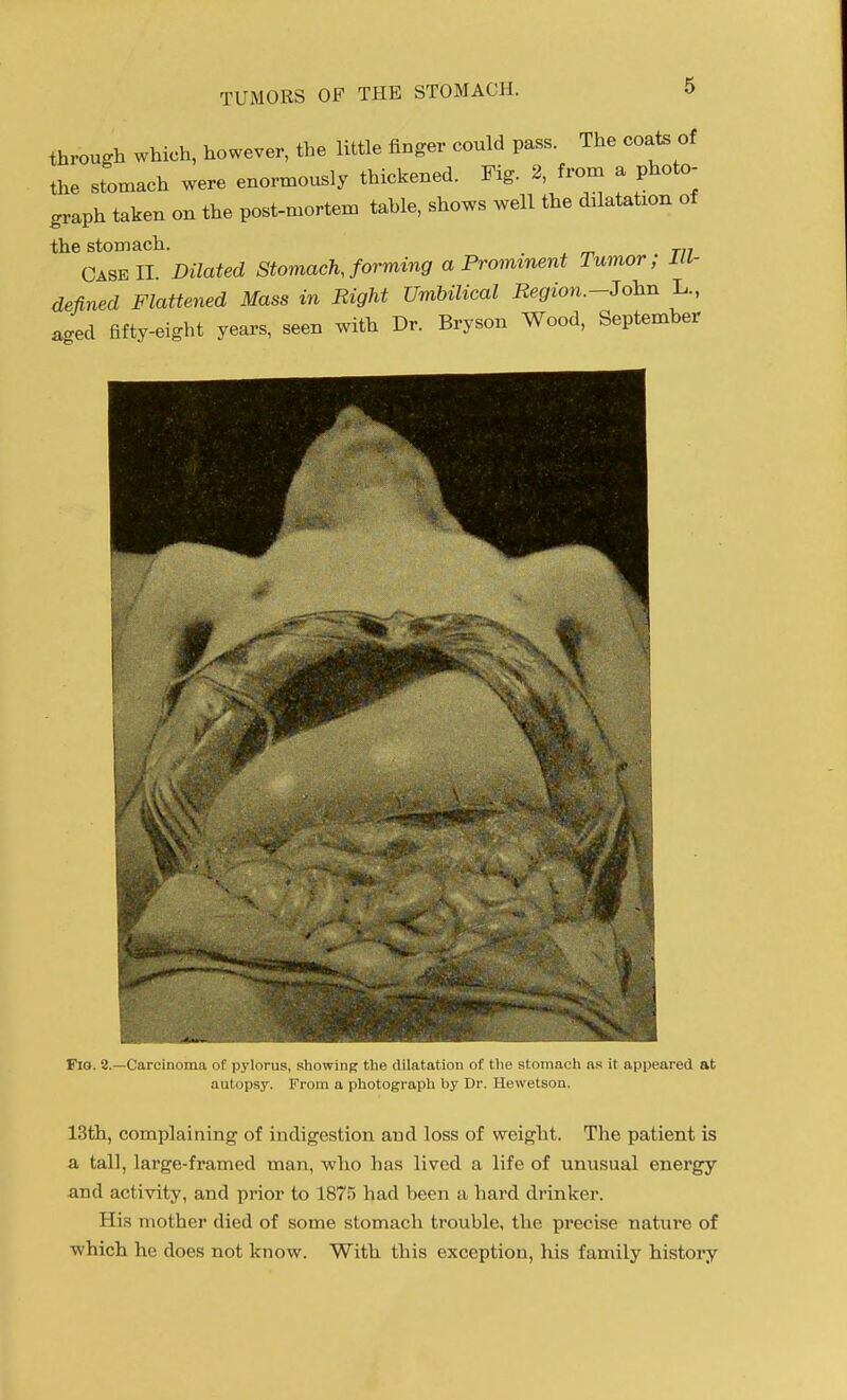 through which, however, the little finger could pass. The coats of tt,e stomach were enormously thickened. Fig. 2, from a photo- graph taken on the post-mortem table, shows well the dilatation of the stomach. ^ Case II. Dilated StomachJorming a Prominent Tumor; Ill- defined Flattened Mass in Bight Umbilical Region.-John L., aged fifty-eight years, seen with Dr. Bryson Wood, September Fig. 2.—Carcinoma of pylorus, showing the (.Ulatation of the stoiuaeli as il appeared at autopsy. From a photograph by Dr. Hewetson. 13th, complaining of indigestion and loss of weight. The patient is a tall, large-framed man, who has lived a life of unusual energy and activity, and prior to 187.5 had been a hard drinker. His mother died of some stomach trouble, the precise nature of which he does not know. With this exception, his family history