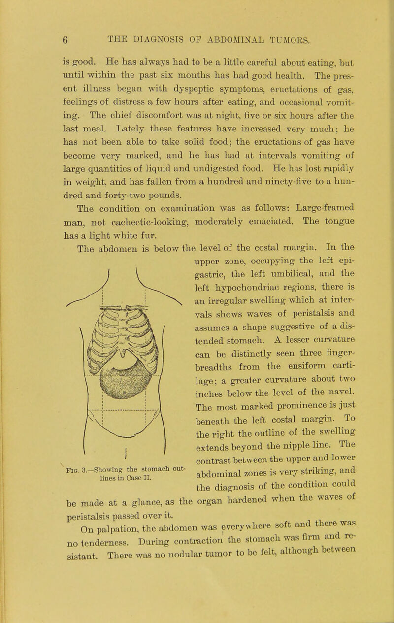 is good. He lias always had to be a little careful about eating, but until within the past six mouths has had good health. The pres- ent illness began with dyspeptic symptoms, eructations of gas, feelings of distress a few hours after eating, and occasional vomit- ing. The chief discomfort was at night, five or six hours after the last meal. Lately these features have increased very much; he has not been able to take solid food; the eructations of gas have become very marked, and he has had at intervals vomiting of large quantities of liquid and undigested food. He has lost rapidly in weight, and has fallen from a hundred and ninety-five to a hun- dred and forty-two pounds. The condition on examination was as follows: Large-framed man, not cachectic-looking, moderately emaciated. The tongue has a light white fur. The abdomen is below the level of the costal margin. In the upper zone, occupying the left epi- gastric, the left umbilical, and the left hypochondriac regions, there is an irregular swelling which at inter- vals shows waves of peristalsis and assumes a shape suggestive of a dis- tended stomach. A lesser curvature can be distinctly seen three finger- breadths from the ensiform carti- lage; a greater curvature about two inches below the level of the navel. The most marked prominence is just beneath the left costal margin. To the right the outline of the swelling extends beyond the nipple line. The contrast between the upper and lower abdominal zones is very striking, and the diagnosis of the condition could be made at a glance, as the organ hardened when the waves of peristalsis passed over it. On palpation, the abdomen was everywhere soft and there was tenderness. During contraction the stomach was firm and re- Fig. 3.—Showing the stomach out- lines in Case II. no sistant. There was no nodular tumor to be felt, although between