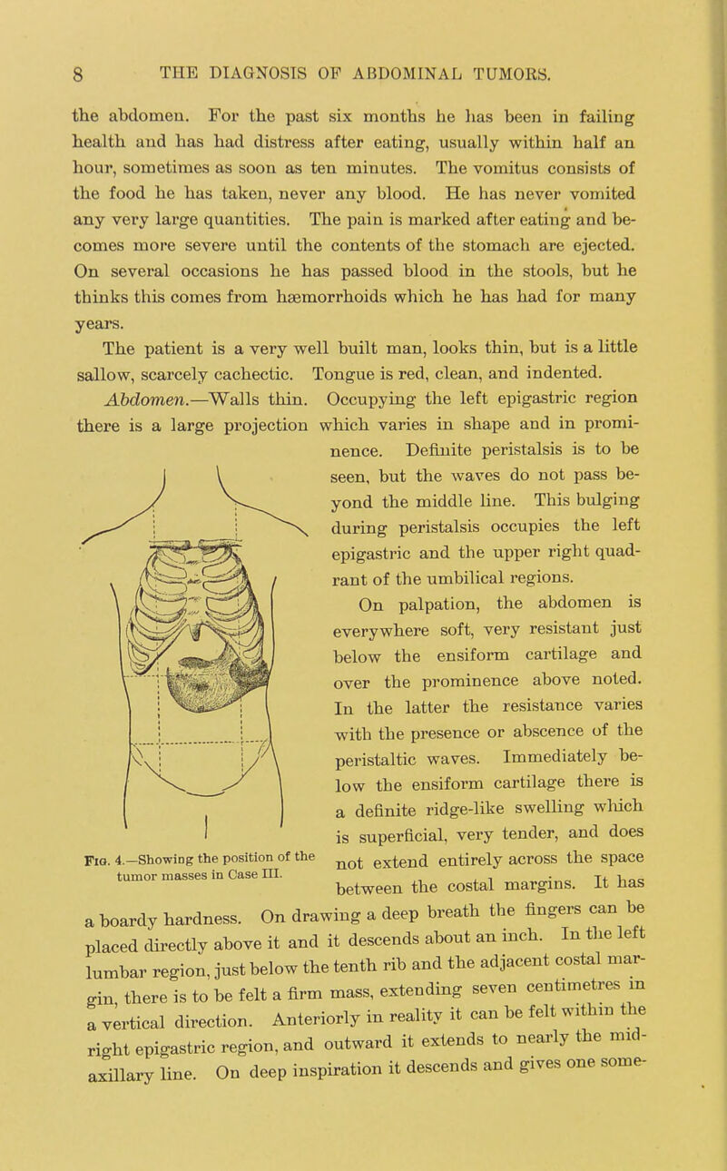 the abdomen. For the past six months he has been in failing health and has had distress after eating, usually within half an hour, sometimes as soon as ten minutes. The vomitus consists of the food he has taken, never any blood. He has never vomited any very large quantities. The pain is marked after eating and be- comes more severe until the contents of the stomach are ejected. On several occasions he has passed blood in the stools, but he thinks this comes from haemorrhoids which he has had for many years. The patient is a very well built man, looks thin, but is a little sallow, scarcely cachectic. Tongue is red, clean, and indented. Abdomen.—^Walls thin. Occupying the left epigastric region there is a large projection which varies in shape and in promi- nence. Definite peristalsis is to be seen, but the waves do not pass be- yond the middle line. This bulging during peristalsis occupies the left epigastric and the upper right quad- rant of the umbilical regions. On palpation, the abdomen is everywhere soft, very resistant just below the ensiform cartilage and over the prominence above noted. In the latter the resistance varies with the presence or abscence of the peristaltic waves. Immediately be- low the ensiform cartilage there is a definite ridge-like swelling wliich is superficial, very tender, and does not extend entirely across the space between the costal margins. It has a boardy hardness. On drawing a deep breath the fingers can be placed directly above it and it descends about an inch. In the left lumbar region, just below the tenth rib and the adjacent costal mar- gin there is to be felt a firm mass, extending seven centimetres m a vertical direction. Anteriorly in reality it can be felt withm the right epigastric region, and outward it extends to nearly the mid- axillary line. On deep inspiration it descends and gives one Fig. 4.—Showing the position of the tumor masses in Case HI. some-