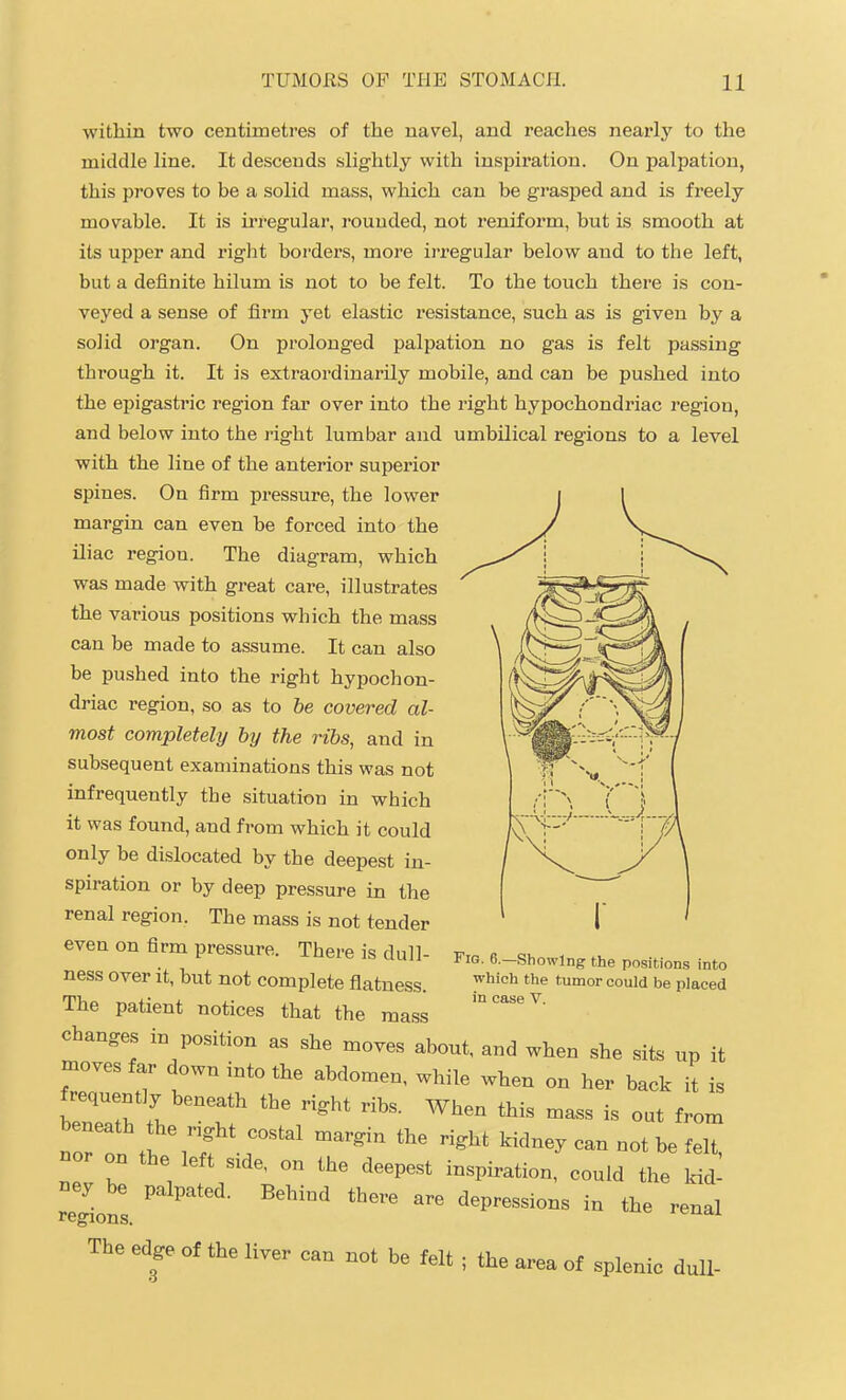 within two centimetres of the navel, and reaches nearly to the middle line. It descends slightly with inspiration. On palpation, this proves to be a solid mass, which can be grasped and is freely movable. It is irregular, rounded, not reniform, but is smooth at its upper and right borders, more irregular below and to the left, but a definite hilum is not to be felt. To the touch there is con- veyed a sense of fii'm yet elastic resistance, such as is given by a solid organ. On prolonged palpation no gas is felt passing through it. It is extraordinarily mobile, and can be pushed into the epigastric region far over into the right hypochondriac region, and below into the right lumbar and umbilical regions to a level with the line of the anterior superior spines. On firm pressure, the lower margin can even he forced into the iliac region. The diagram, which was made with great care, illustrates the various positions which the mass can be made to assume. It can also be pushed into the right hypochon- driac region, so as to he covered al- most completely by the ribs, and in subsequent examinations this was not infrequently the situation in which it was found, and from which it could only be dislocated by the deepest in- spiration or by deep pressure in the renal region. The mass is not tender even on firm pressure. There is dull- ness over it, but not complete flatness. The patient notices that the mass changes in position as she moves about, and when she sits up it moves far down into the abdomen, while when on her back it is frequently beneath the right ribs. When this mass is out from beneath the nght costal margin the right kidney can not be felt, nor on the left side, on the deepest inspiration, could the Irid^ ney be palpated. Behind there are depressions in the renal regions. ieudi The edge of the liver can not be felt ; the area of splenic dull- Fig. 6.—Showing the positions into which the tumor could be placed in case V.