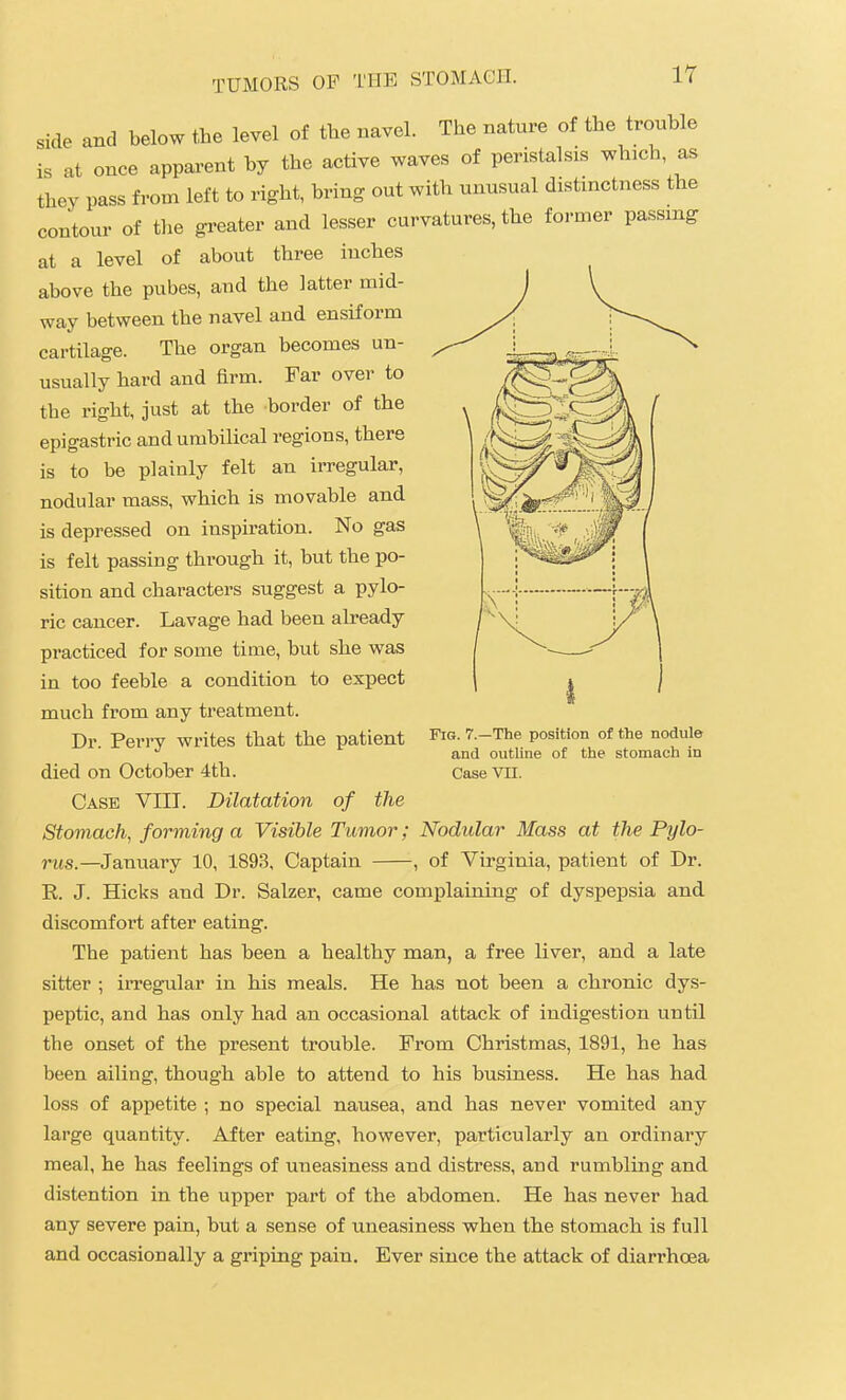 side and below the level of the navel. The nature of the trouble is at once apparent by the active waves of peristalsis which, as they pass from left to right, bring out with unusual distinctness the contour of the greater and lesser curvatures, the former passing at a level of about three inches above the pubes, and the latter mid- way between the navel and ensiform cartilage. The organ becomes un- usually hard and firm. Far over to the right, just at the border of the epigastric and umbilical regions, there is to be plainly felt an irregular, nodular mass, which is movable and is depressed on inspiration. No gas is felt passing through it, but the po- sition and characters suggest a pylo- ric cancer. Lavage had been already practiced for some time, but she was in too feeble a condition to expect much from any treatment. Dr. Perry writes that the patient died on October 4th. Case VIII. Dilatation of the Stomach, forming a Visible Tumor; Nodular Mass at the Pylo- rus.—Jarmavj 10, 1893, Captain , of Virginia, patient of Dr. E. J. Hicks and Dr. Salzer, came complaining of dyspepsia and discomfort after eating. The patient has been a healthy man, a free liver, and a late sitter ; irregular in his meals. He has not been a chronic dys- peptic, and has only had an occasional attack of indigestion until the onset of the present trouble. From Christmas, 1891, he has been ailing, though able to attend to his business. He has had loss of appetite ; no special nausea, and has never vomited any large quantity. After eating, however, particularly an ordinary meal, he has feelings of uneasiness and distress, and rumbling and distention in the upper part of the abdomen. He has never had any severe pain, but a sense of uneasiness when the stomach is full and occasionally a griping pain. Ever since the attack of diarrhoea Fig. 7.—The position of the nodule and outline of the stomach in Case Vn.