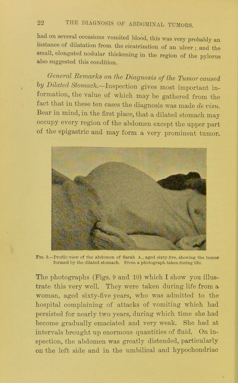 had on several occasions vomited blood, this was very probably an instance of dilatation from the cicatrization of an ulcer ; and the small, elongated nodular thickening in the region of the pylorus also suggested this condition. General Remarks on the Diagnosis of the Tumor caused by Dilated Stomach.—Insipection gives most important in- formation, the value of which may be gathered from the fact that in these ten cases the diagnosis was made de visit. Bear in mind, in the first place, that a dilated stomach may occupy every region of the abdomen except the upper part of the epigastric and may form a very prominent tumor. Fig. 9.—Profile view of the abdomen of Sarah A., aged sixty-five, showing the tumor formed by the dilated stomach. From a photograph taken dm-ing life. The photographs (Figs. 9 and 10) which I show you illus- trate this very well. They were taken during life from a woman, aged sixty-five years, who was admitted to the hospital complaining of attacks of vomiting which had persisted for nearly two years, during which time she had become gradually emaciated and very weak. She had at intervals brought up enormous quantities of fiuid. On in- spection, the abdomen was greatly distended, particularly on the left side and in the umbilical and hypochondriac
