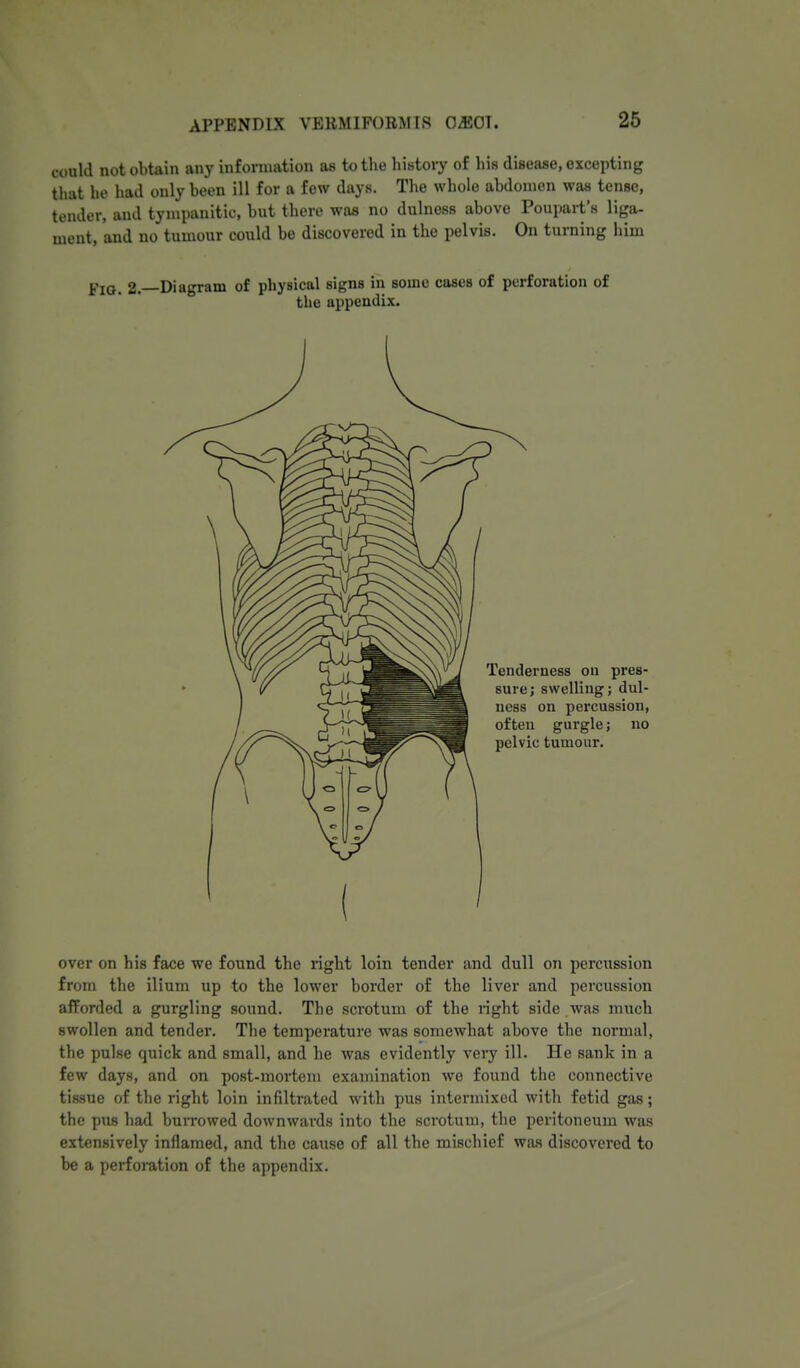could not obtain any information as to the history of his disease, excepting that ho had only been ill for a few days. The whole abdomen was tense, tender, and tympanitic, but there was no dulness above Poupart's liga- ment, and no tumour could be discovered in the pelvis. On turning him Fia. 2—Diagram of physical signs in some cases of perforation of the appendix. over on his face we found the right loin tender and dull on percussion from the ilium up to the lower border of the liver and percussion afforded a gurgling sound. The scrotum of the right side was much swollen and tender. The temperature was somewhat above the normal, the pulse quick and small, and he was evidently very ill. He sank in a few days, and on post-mortem examination we found the connective tissue of the right loin infiltrated with pus intermixed with fetid gas; the pus had bun-owed downwards into the scrotum, the peritoneum was extensively inflamed, and the cause of all the mischief was discovered to be a perforation of the appendix.