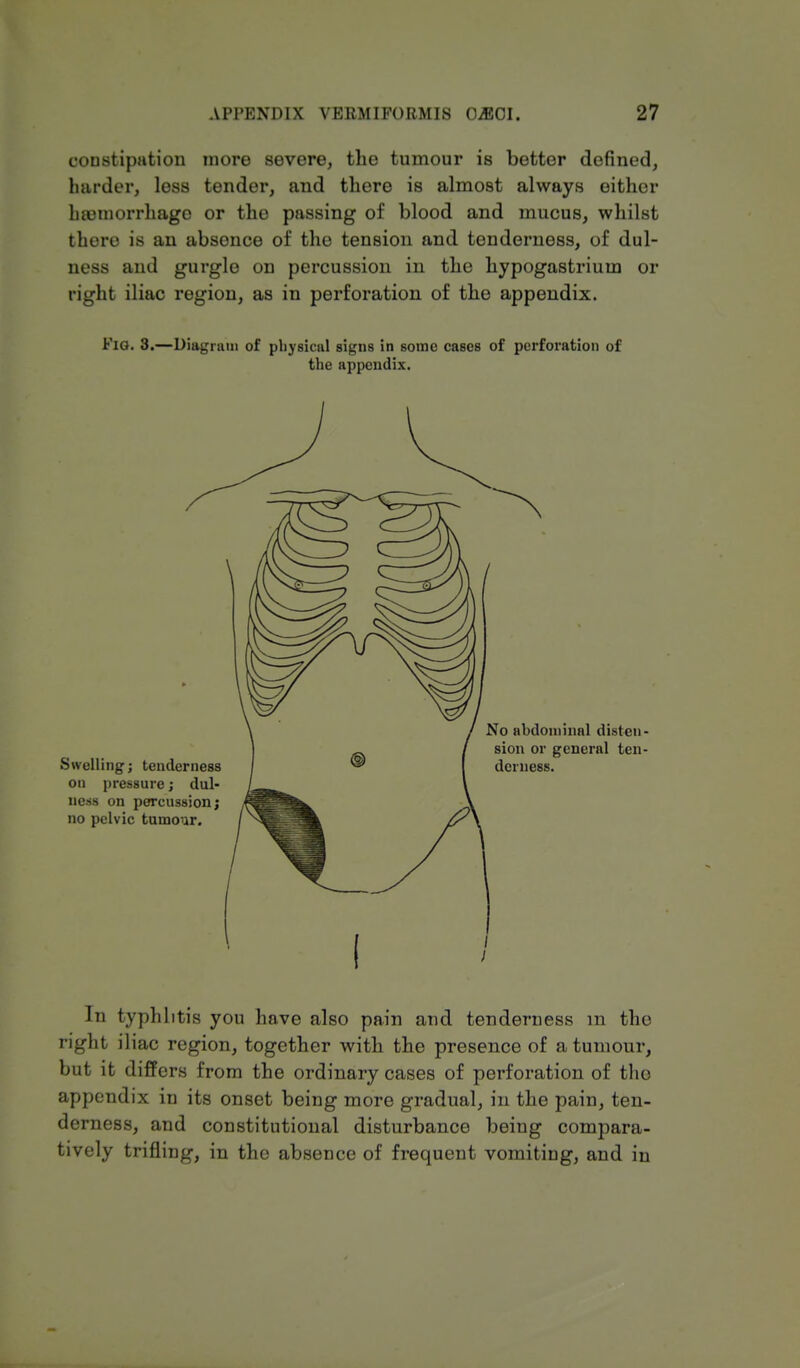 constipation more severe, the tumour is better defined, harder, less tender, and there is almost always either haemorrhage or the passing of blood and mucus, whilst there is an absence of the tension and tenderness, of dul- ness and gurgle on percussion in the hypogastriuin or right iliac region, as in perforation of the appendix. Fig. 3.—Diagram of physical signs in some cases of perforation of the appendix. In typhlitis you have also pain and tenderness m the right iliac region, together with the presence of a tumour, but it differs from the ordinary cases of perforation of the appendix in its onset being more gradual, in the pain, ten- derness, and constitutional disturbance being compara- tively trifling, in the absence of frequent vomiting, and in