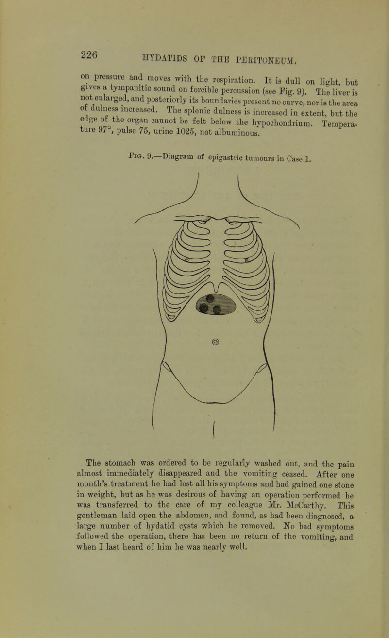 on pressure and moves with the respiration. It is dull on light, but gives a tympanitic sound on forcible percussion (see Fig. 9). The liver is not enlarged, and posteriorly its boundaries present no curve, nor is the area ot dulness increased. The splenic dulness is increased in extent, but the edge of the organ cannot be felt below the hypochondrium. Tempera- ture 9/°, pulse 75, urine 1025, not albuminous. Fia. 9.—Diagram of epigastric tumours in Case 1. The stomach was ordered to be regularly washed out, and the pain almost immediately disappeared and the vomiting ceased. After one month's treatment he had lost all his symptoms and had gained one stone in weight, but as he was desirous of having an operation performed he was transferred to the care of my colleague Mr. McCarthy. This gentleman laid open the abdomen, and found, as had been diagnosed, a large number of hydatid cysts which he removed. No bad symptoms followed the operation, there has been no return of the vomiting, and when I last heard of him he was nearly well.