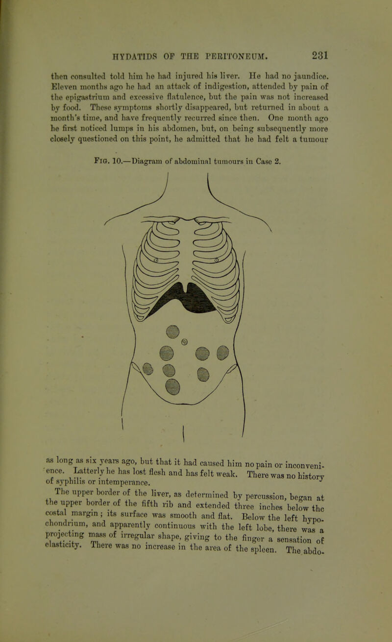 then consulted told him he had injured his liver. He had no jaundice. Eleven months ago he had an attack of indigestion, attended by pain of the epigastrium and excessive flatulence, but the pain was not increased by food. These symptoms shortly disappeared, but returned in about a month's time, and have frequently recurred since then. One month ago he first noticed lumps in his abdomen, but, on being subsequently more closely questioned on this point, he admitted that he had felt a tumour Fig. 10.—Diagram of abdominnl tumours in Case 2. as long aa six years ago, but that it had caused him no pain or inconveni- ence. Latterly he has lost flesh and has felt weak. There was no history or syphilis or intemperance. The upper border of the liver, as determined by percussion, began at the upper border of the fifth rib and extended three inches below the costal margin j its surface was smooth and flat. Below the left hypo chondr.um, and apparently continuous with the left lobe, there was a projecting mass of irregular shape, giving to the finger a sensation of elasticity. There was no increase in the area of the spleen. The abdo