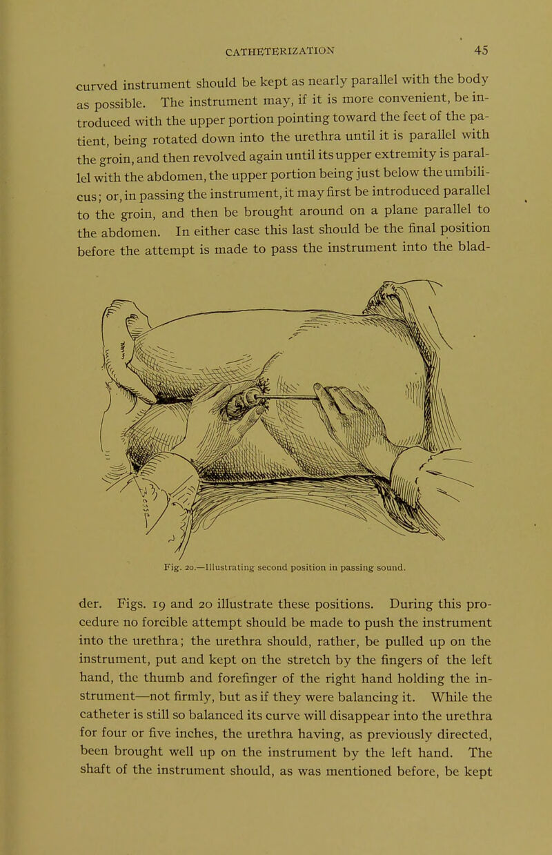 curved instrument should be kept as nearly parallel with the body as possible. The instrument may, if it is more convenient, be in- troduced with the upper portion pointing toward the feet of the pa- tient, being rotated down into the urethra until it is parallel with the groin, and then revolved again until its upper extremity is paral- lel with the abdomen, the upper portion being just below the umbili- cus ; or, in passing the instrument, it may first be introduced parallel to the groin, and then be brought around on a plane parallel to the abdomen. In either case this last should be the final position before the attempt is made to pass the instrument into the blad- Fig. 20.—Illustrating second position in passing sound. der. Figs. 19 and 20 illustrate these positions. During this pro- cedure no forcible attempt should be made to push the instrument into the urethra; the urethra should, rather, be pulled up on the instrument, put and kept on the stretch by the fingers of the left hand, the thumb and forefinger of the right hand holding the in- strument—not firmly, but as if they were balancing it. While the catheter is still so balanced its curve will disappear into the urethra for four or five inches, the urethra having, as previously directed, been brought well up on the instrument by the left hand. The shaft of the instrument should, as was mentioned before, be kept