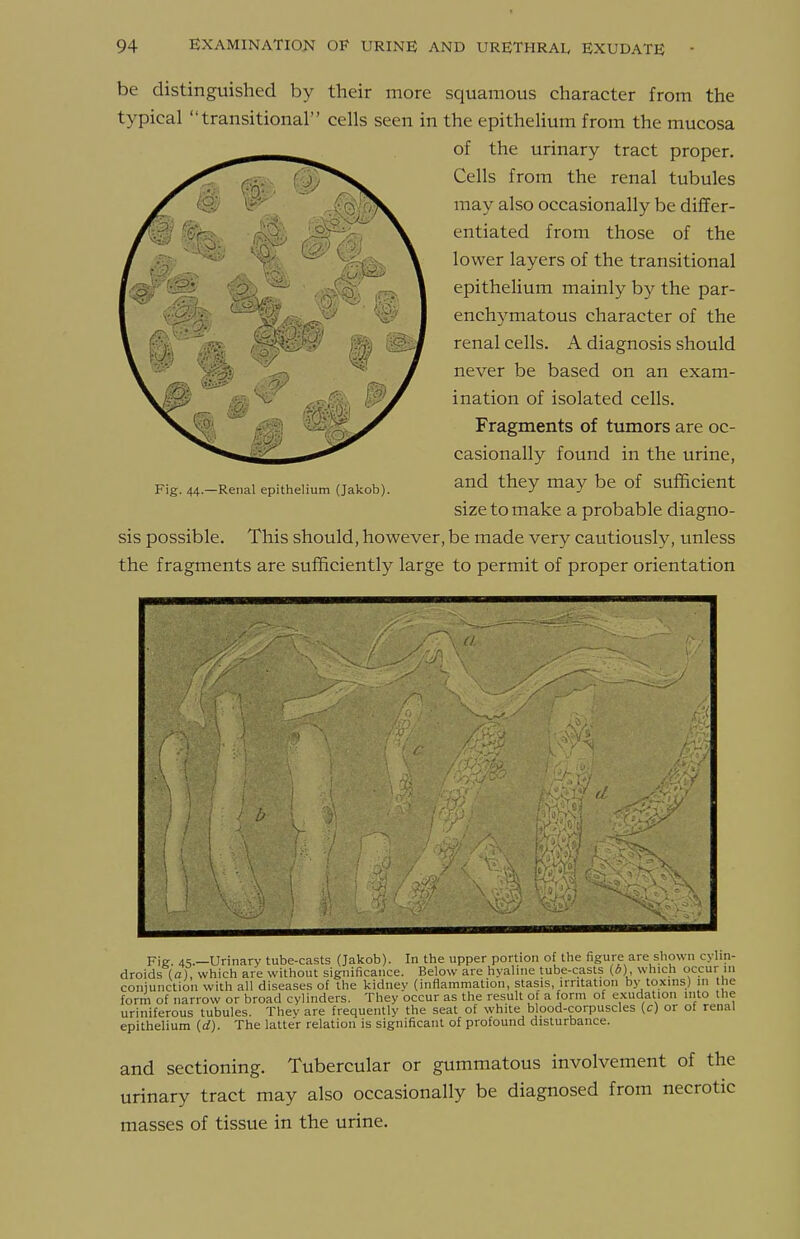 be distinguished by their more squamous character from the typical transitional cells seen in the epithelium from the mucosa of the urinary tract proper. Cells from the renal tubules may also occasionally be differ- entiated from those of the lower layers of the transitional epithehum mainly by the par- enchymatous character of the renal cells. A diagnosis should never be based on an exam- ination of isolated cells. Fragments of tumors are oc- casionally found in the urine, and they may be of sufficient size to make a probable diagno- sis possible. This should, however, be made very cautiously, unless the fragments are sufficiently large to permit of proper orientation Fig. 44.—Renal epithelium (Jakob). form of narrow or broad cylinders. They occur as the result of a form of exudation into the uriniferous tubules. Thev are frequently the seat of white blood-corpuscles (c) or of renal epithelium (d). The latter relation is significant of profound disturbance. and sectioning. Tubercular or gummatous involvement of the urinary tract may also occasionally be diagnosed from necrotic masses of tissue in the urine.