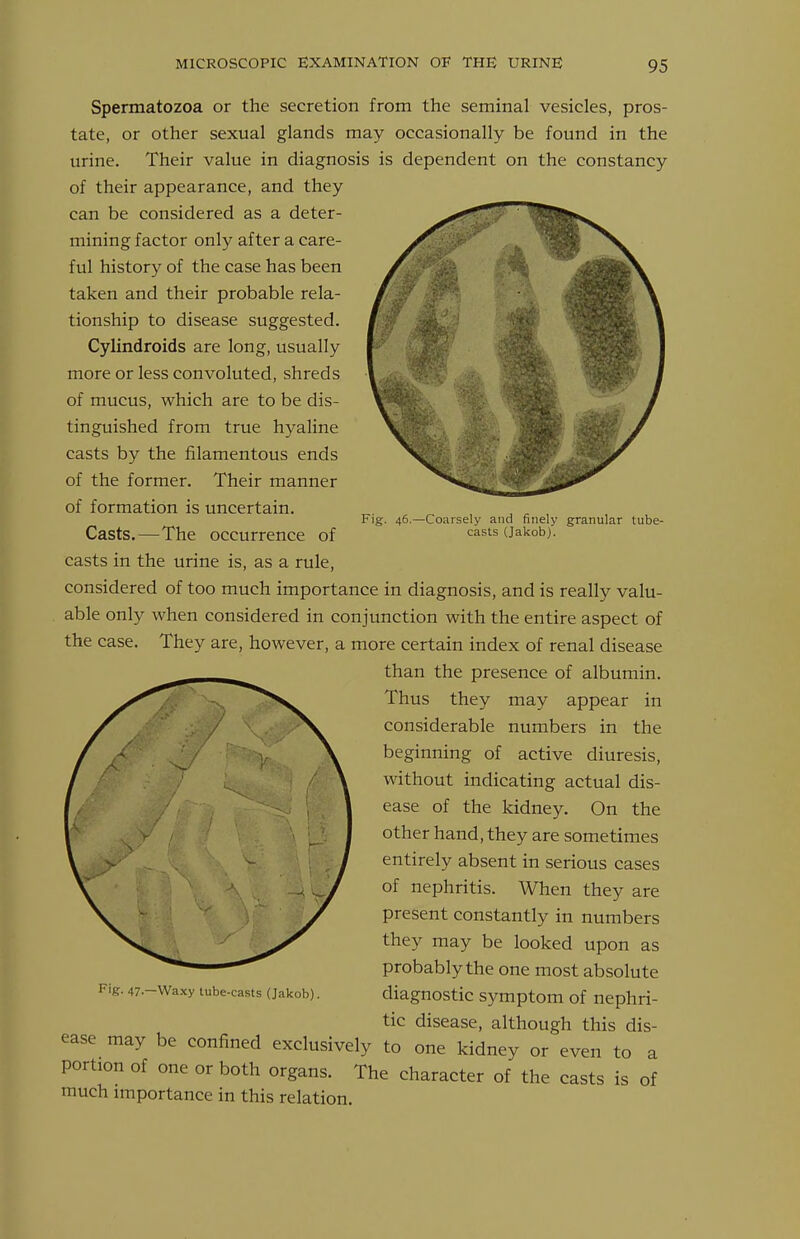 Fig. 46.—Coarsely and finely granular tube- casts (Jakob). Spermatozoa or the secretion from the seminal vesicles, pros- tate, or other sexual glands may occasionally be found in the urine. Their value in diagnosis is dependent on the constancy of their appearance, and they can be considered as a deter- mining factor only after a care- ful history of the case has been taken and their probable rela- tionship to disease suggested. Cylindroids are long, usually more or less convoluted, shreds of mucus, which are to be dis- tinguished from true hyaline casts by the filamentous ends of the former. Their manner of formation is uncertain. Casts.—The occurrence of casts in the urine is, as a rule, considered of too much importance in diagnosis, and is really valu- able only when considered in conjunction with the entire aspect of the case. They are, however, a more certain index of renal disease than the presence of albumin. Thus they may appear in considerable numbers in the beginning of active diuresis, without indicating actual dis- ease of the kidney. On the other hand, they are sometimes entirely absent in serious cases of nephritis. When they are present constantly in numbers they may be looked upon as probably the one most absolute diagnostic symptom of nephri- tic disease, although this dis- ease may be confined exclusively to one kidney or even to a portion of one or both organs. The character of the casts is of much importance in this relation.