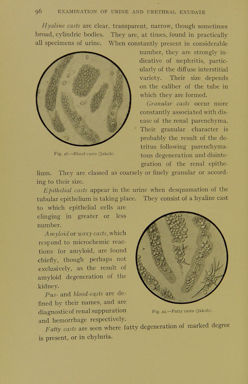 Fig. 48.—.Blood-casts (Jakob). Hyaline casts are clear, transparent, narrow, though sometimes broad, cylindric bodies. They are, at times, found in practically all specimens of urine. When constantly present in considerable number, they are strongly in- dicative of nephritis, partic- ularly of the diffuse interstitial variety. Their size depends on the caliber of the tube in which they are formed. Granular casts occur more constantly associated with dis- ease of the renal parenchyma. Their granular character is probably the result of the de- tritus following parenchyma- tous degeneration and disinte- gration of the renal epithe- lium. They are classed as coarsely or finely granular or accord- ing to their size. Epithelial casts appear in the urine when desquamation of the tubular epitheUum is taking place. They consist of a hyaline cast to which epithelial cells are clinging in greater or less number. Amyloid or waxy casts, which respond to microchemic reac- tions for amyloid, are found chiefly, though perhaps not exclusively, as the result of amyloid degeneration of the kidney. Pus- and blood-casts are de- fined by their names, and are and hemorrhage respectively. Fatty casts are seen where fatty degeneration of marked degree is present, or in chyluria.