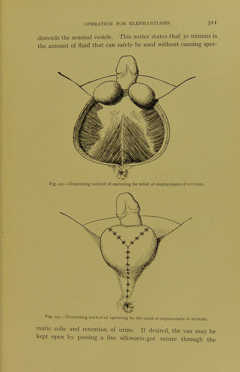 OPERATION FOR ELEPHANTIASIS distends the seminal vesicle. This writer states that 30 minims is the amount of fluid that can safely be used without causing sper- Fig. 242.—Illustrating method of operating for relief of elephantiasis of scrotum. Fig. 243.-llhistraling method of operating for the relief of elephantiasis of scrotum. matic colic and retention of urine. If desired, the vas may be kept open by passing a fine silkworm-gut suture through the