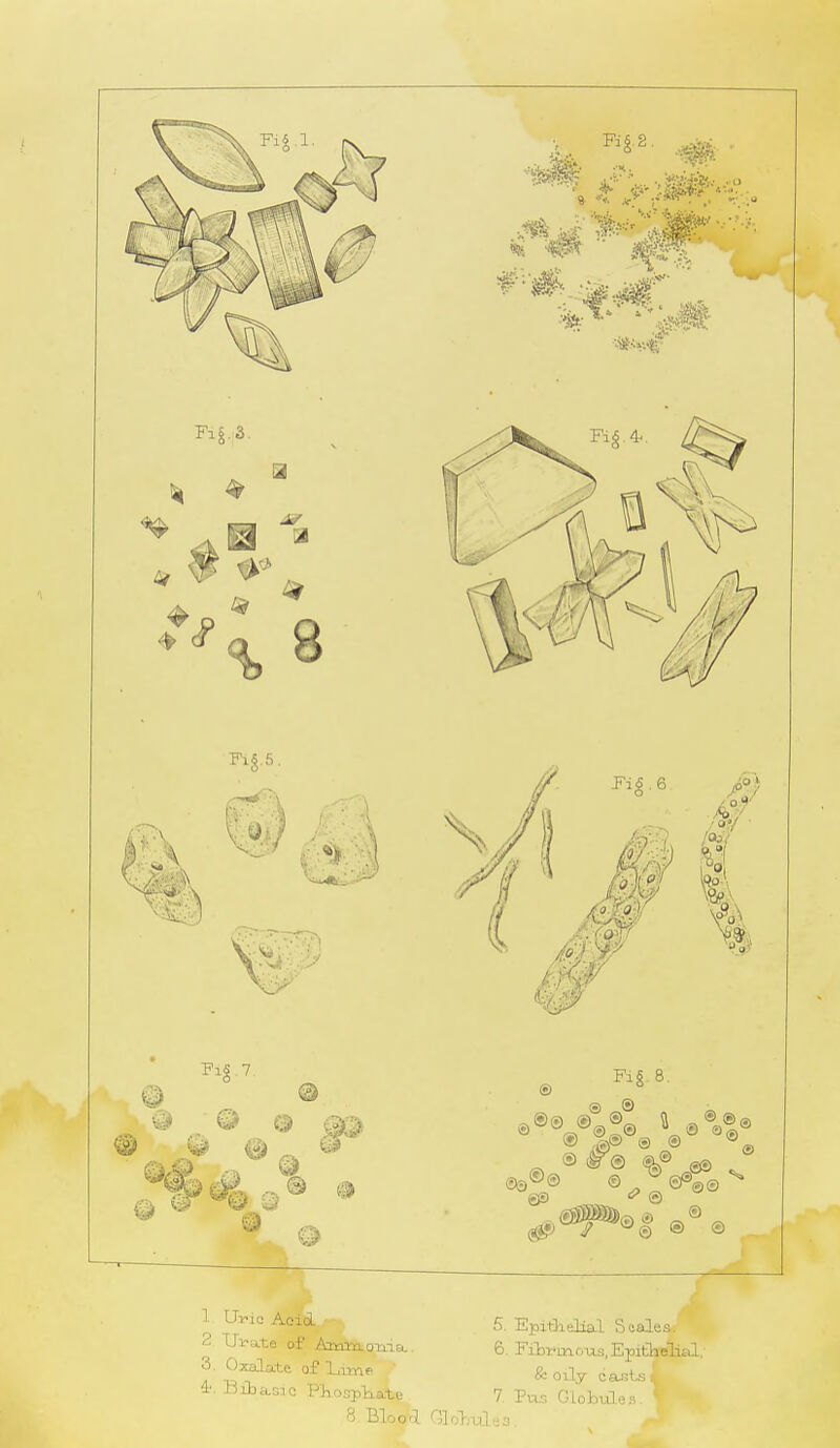 Fig. 7. ® • o © © ■J Fig. 8. 1 UVic Aoid 2 Urate of Aaaaonia.. 3. Oxalate of Lime * 4. Bibasic Ph.osph.ate 8. BW1 5. Epithelial Saalea. 6. Fibrinous, Epithelial. & oily casts 1 7. Pus Globules, wl Globules