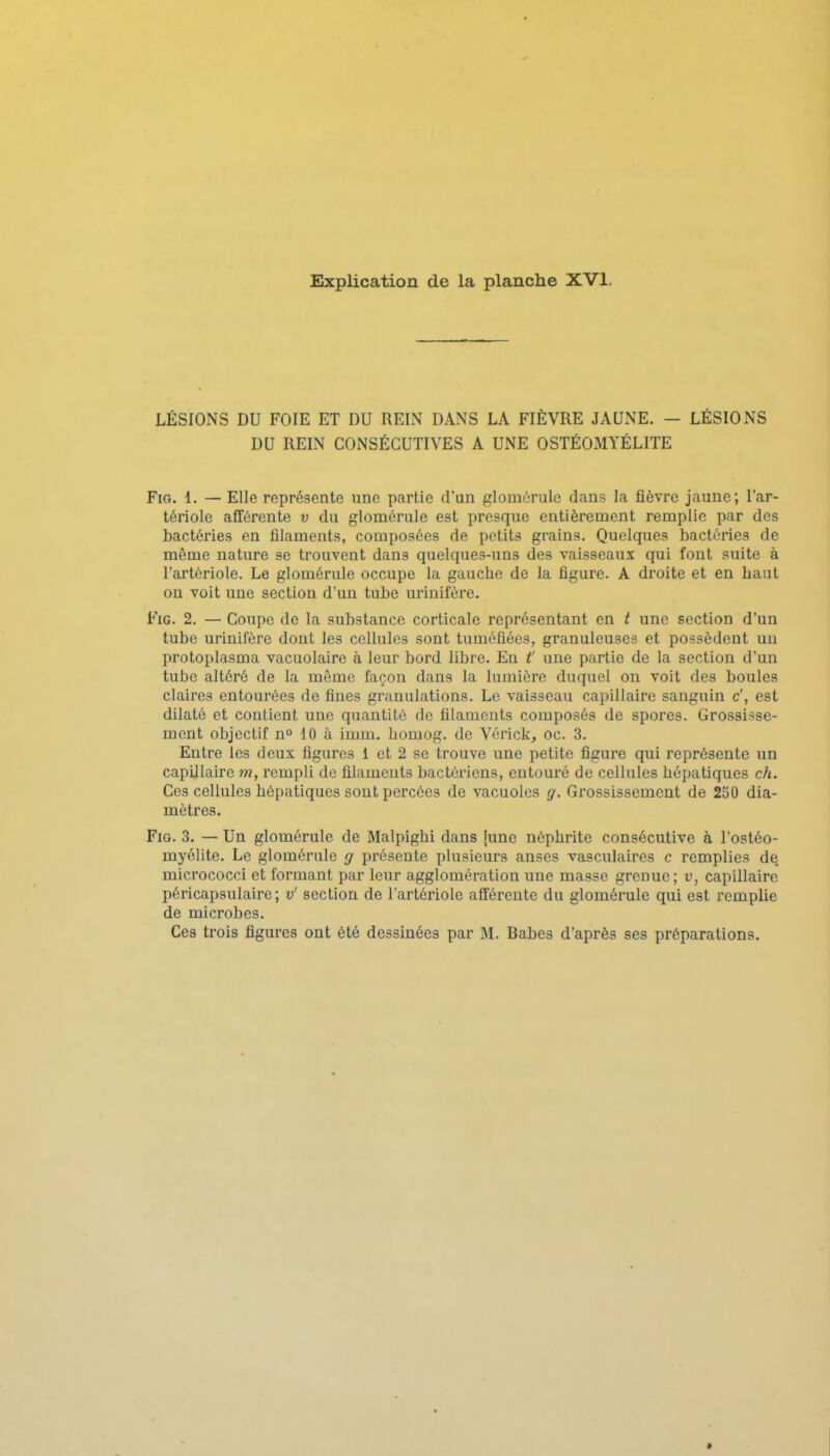 Explication de la planche XVI. LÉSIONS DU FOIE ET DU REIN DANS LA FIÈVRE JAUNE. — LÉSIONS DU REIN CONSÉCUTIVES A UNE OSTÉOMYÉLITE FiG. 1. — Elle représente une partie d'un glomcrulc dans la fièvre jaune; l'ar- tériole afférente v du glomérule est presque entièrement remplie par des bactéries en filaments, composées de petits grains. Quelques bactéries de même nature se trouvent dans quelques-uns des vaisseaux qui font suite à l'artériole. Le glomérule occupe la gauche de la figure. A droite et en haut on voit une section d'un tube urioifère. FiG. 2. — Coupe de la substance corticale représentant en t une section d'un tube urinifère dont les cellules sont tuméfiées, granuleuses et possèdent un protoplasma vacuolaire à leur bord libre. Eu f une partie de la section d'un tube altéré de la même façon dans la lumière duquel on voit des boules claires entourées de fines granulations. Le vaisseau capillaire sanguin c', est dilaté et contient une quantité de filaments composés de spores. Grossisse- ment objectif no 10 à imm, homog. de Vérick, oc. 3. Entre les deux figures 1 et 2 se trouve une petite figure qui représente un capillaire m, l'empIi de filaments bactériens, entouré de cellules hépatiques ch. Ces cellules hépatiques sont percées de vacuoles g. Grossissement de 250 dia- mètres. FiG. 3. — Un glomérule de Malpighi dans |uno néphrite consécutive à l'ostéo- myélite. Le glomérule g présente plusieurs anses vasculaires c remplies de. micrococci et formant par leur agglomération une masse grenue; v, capillaire péricapsulaire ; v' section de l'artériole afférente du glomérule qui est remplie de microbes. Ces trois figures ont été dessinées par M. Babes d'après ses préparations.