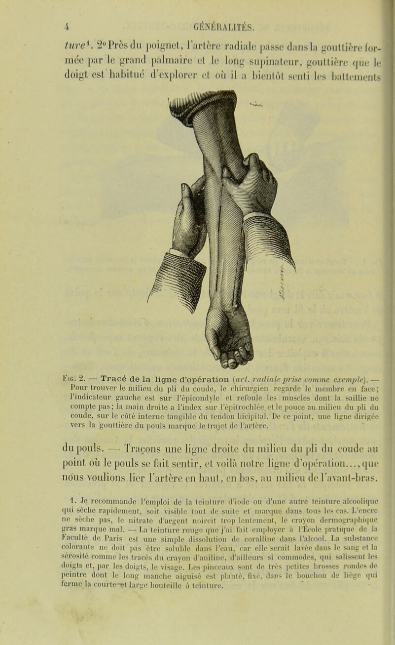 tnreK 2° Près du poignet, l'artère radiale passe dans la gouttière for-! niée |>,ir le grand palmaire el le long supinateur, gouttière que le doigt est haBitué d'explorer el où il a biehtôl senti les battements Fie. 2. — Tracé de la ligne d'opération (art. radiale prise comme exemple). — Pour trouver le milieu du pli du coude, le chirurgien regarde le membre en face; l'indicateur gauche est sur l'épicondyle et refoule les muscles dont la saillie ne compte pas; la main droite a l'index sur l'épilrochléc et le pouce au milieu du pli du coude, sur le côté interne tangible du tendon bicipilal. De ce point, i ligne dirigée vers la gouttière du pouls marque le trajet de l'artère. dit pouls. — Traçons une ligne droite du milieu du pli du coude au point où le pouls se f;iit sentir, el voilà notre ligne d'opération...,que nous voulions lier l'artère en haut, en bas, au milieu de lavant-bras. ï. Je recommande l'emploi de la teinture d'iode ou d'une autre teinture alcoolique qui sèche rapidement, suit visible tout de suite el marque dans tous les cas. L'encre ne sèche pas, le nitrate d'argent noircit trop lentement, le crayon démographique gras marque mal.—La teinture rouge que j'ai l'ail employer à l'Ecole pratique de la Faculté de Paris est une simple dissolution de coralline dans l'alcool. La substance colorante ne doit pas être soluble dans l'eau, car elle serait lavée dans le sang el ta sérosité comme les tracés du crayon d'aniline, d'ailleurs si commodes, qui salissent les doigta et, par les doigts, le.visage. Les pinceaux sont de très petites brosses r les de peintre dont le long manche aiguisé est piaulé, fixé, dan- le bouchon de liège qui ferme la courte cl large bouteille à teinture.