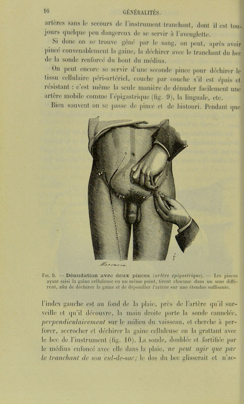 artères sans le secours de l'iastauoeat tranchant, dont il est toJ jours quelque peu dangereus de se servir l'aveuglette. Si donc on se trouve gêné par le sang, on peu*, après avoil pincé convenablement la gaine, la déchirer avec le tranchant du bel de la sonde renforcé du bout du médius; On peut encore se servir d'une seconde pince pour déchirer le tissu cellulaire péri-artériel, couche par couche s'il est épais et résistant : c'est même la seule manière de dénuder facilement une artère mobile connue l epigastrique (fig. 9), la linguale, etc. Bien souvent on se passe de pince et de bistouri. Pendant nue Fus. 9. — Dénudation avec deux pinces [artère èpigaslrique). — Les pinces ayant saisi la gainé ceîluleuse en un même point, tirent chacune dans un sens (titrè- rent, alin île déchirer la gaine et de dépouiller l'artère sur une étendue suffisante, l'index gauche est au fond de la plaie, près de l'artère qu'il sur- veille et qu'il découvre, la main droite porte la sonde cannelée. perpendiculairement sur le milieu du vaisseau, et cherche à per- forer, accrocher el déchirer la gaine ceîluleuse en la grattant avec le bec de l'instrument (fig. 10). La sonde, doublée el fortifiée par le médius enfoncé avec elle dans la plaie, ne peut agir que /un- ie tranchant de son cul-de-sac; le dos du bec glisserait et n'ai-