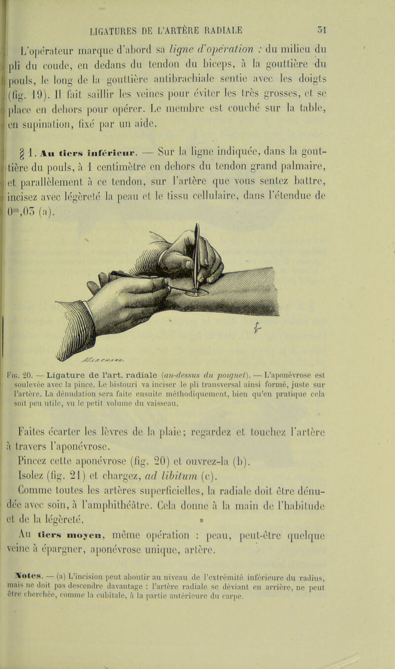 L'opérateur marque d'abord sa ligne d'opération : du milieu du pli du coude, en dedans du tendon du biceps, à la gouttière du pouls, le long de la gouttière antibrachiale sentie avec les doigts (fig. 11)). Il l'ait saillir les veines pour éviter les 1res grosses, cl se place eu dehors pour opérer. Le membre esl couché sur la table, eu supination, fixé par un aide. g 1. Au tiers Inférieur. — Sur la ligne indiquée, dans la gout- tière du pouls, à 1 centimètre en dehors du tendon grand palmaire, et parallèlement à ce tendon, sur l'artère que vous sentez battre, incisez avec légèreté la peau et le tissu cellulaire, dans l'étendue de 0*03 fa). Fin. 20. — Ligature de l'art, radiale (au-dessus du poignet). — L'aponévrose est soulevée avec la pince. Le bistouri va inciser le pli transversal ainsi formé, juste sur l'artère. La déiuulation sera laite ensuite méthodiquement, bien qu'en pratique cela soil peu utile, vu le petil volume du vaisseau. faites écarter les lèvres de la plaie; regardez et louchez l'artère à travers l'aponévrose. Pincez cette aponévrose (fig. 20) et ouvrez-la (b). Isolez (fig. 21) et chargez, ad libitum (e). Comme toutes les artères superficielles, la radiale doit être dénu- dée avec soin, à l'amphithéâtre. Cela donne à la main de l'habitude et de la légèreté. • Au tiers moyeu, même opération : peau, peut-être quelque veilie à épargner, aponévrose unique, artère. ]%ot<*H. — (a) L'incision peut aboutir au niveau de l'extrémité inférieure du radius. mais 'oïl pas descendre da\ âge : l'artère radiale se déviant eu arrière, ne peut Btre cherchée, comme la cubitale, à la partie antérieure du carpe.