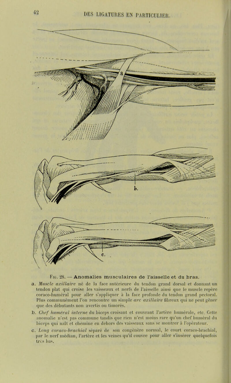 a. Muscle axillaire né de l;i face antérieure du tendon grand dorsal et donnant un tendon plat qui croise les vaisseaux el un is de l'aisselle ainsi crue le muscle repère coraco-huméral ]>our aller s'appliquer à la face profonde <ln tendon grand pectoral. Plus communément l'on rencontre un simple arc axillaire Ubreus qui ne peut gêner que des débutants non avertis ou timorés. b. Chef humerai interne du biceps croisant et couvrant Tarière huméralc, etc. Cette anomalie n'est pas commune tandis que rien n'est moins rare qu'un chef humerai du biceps qui naît et ebémine en dehors des vaisseaux sans se montrer ;'i l'opérateur. c. Long boraco-brachial séparé de son congénère normal, le court coraco-bruchia], par le nerf médian, l'artère et les veines qu'il couvre pour aller s'insérer quelquefois 1res bas.