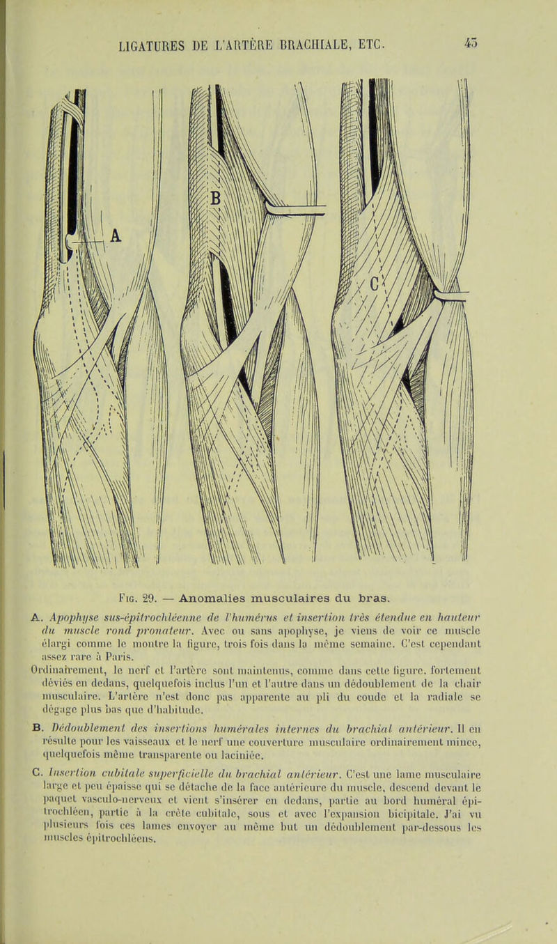 Fig. 29. — Anomalies musculaires du bras. A. Apophyse sus-épitrochléenne de l'humérus et insertion 1res étendue en hauteur du muscle rond pronateur. Avec ou sans apophyse, je viens de voir ce muscle élargi comme, le montre la figure, trois fois dans la même semaine. C'esl cependant assez rare ;'i Paris. Ordinairement, le nerf et l'artère sont maintenus, connue dans cette ligure, fortement déviés en dedans, quelquefois inclus l'un et l'autre dans un dédoublement de la chair musculaire. L'artère n'est donc pas apparente au pli du coude et ta radiale se dégage plu- bas que d'habitude. B. Dédoublement des insertions huméroles internes du braphial /intérieur. 11 en résulte pour les vaisseaux et le nerf une couverture musculaire ordinairement mince, quelquefois même transparente ou laciniée. C. Insertion cubitale superficielle du brachial antérieur. C'est une hune musculaire large el peu épaisse qui se détache de la face antérieure du muscle, descend devant le paquet vasculo-nerveux et vient s'insérer en dedans, partie au bord humerai épi- trochléen, partie à la crête cubitale, sous et avec l'expansion bicipitale. J'ai vu plusieurs lois ces hunes envoyer au même but un dédoublement par-dessous les muscles èpitrocblôens.